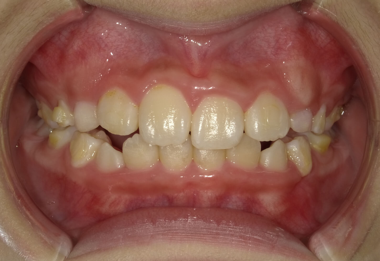 施術後の口内写真01