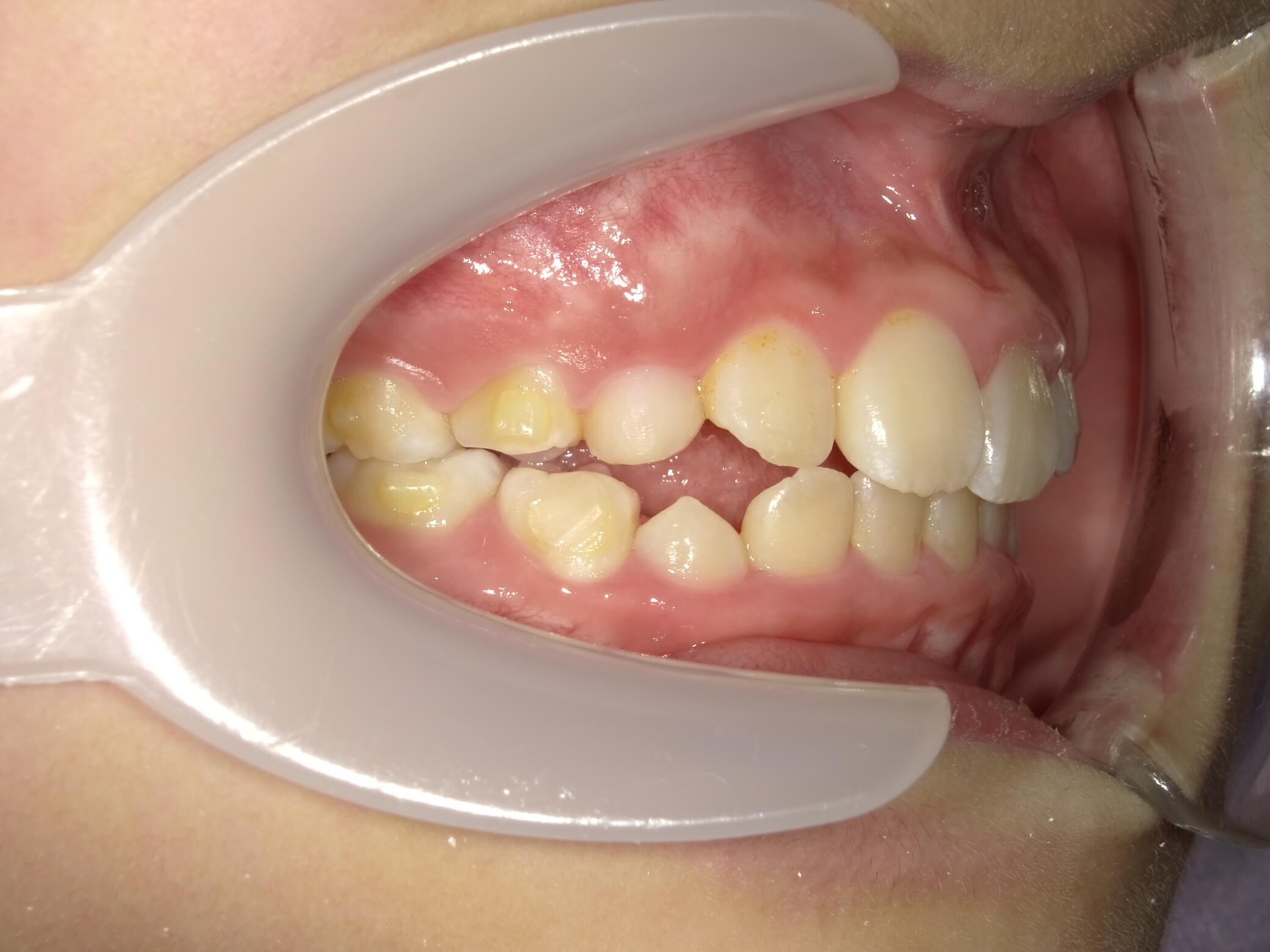 施術後の口内写真02