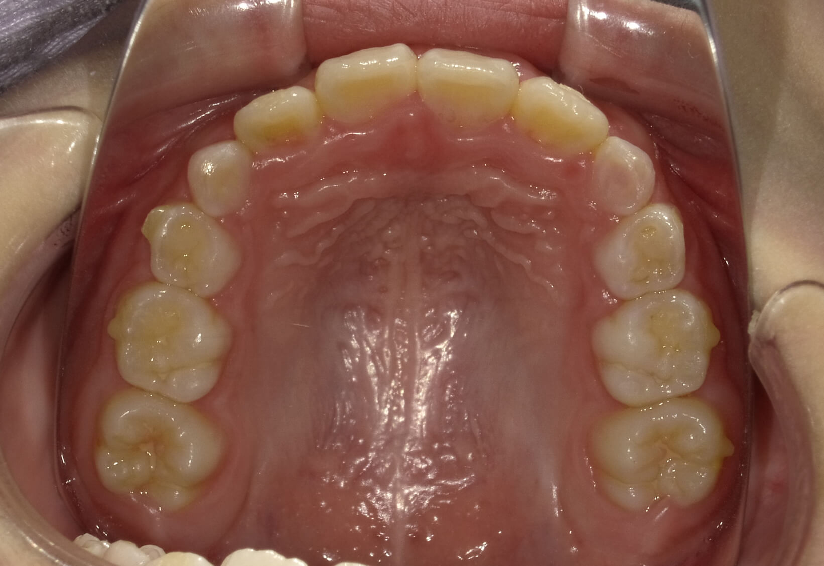 施術後の口内写真04