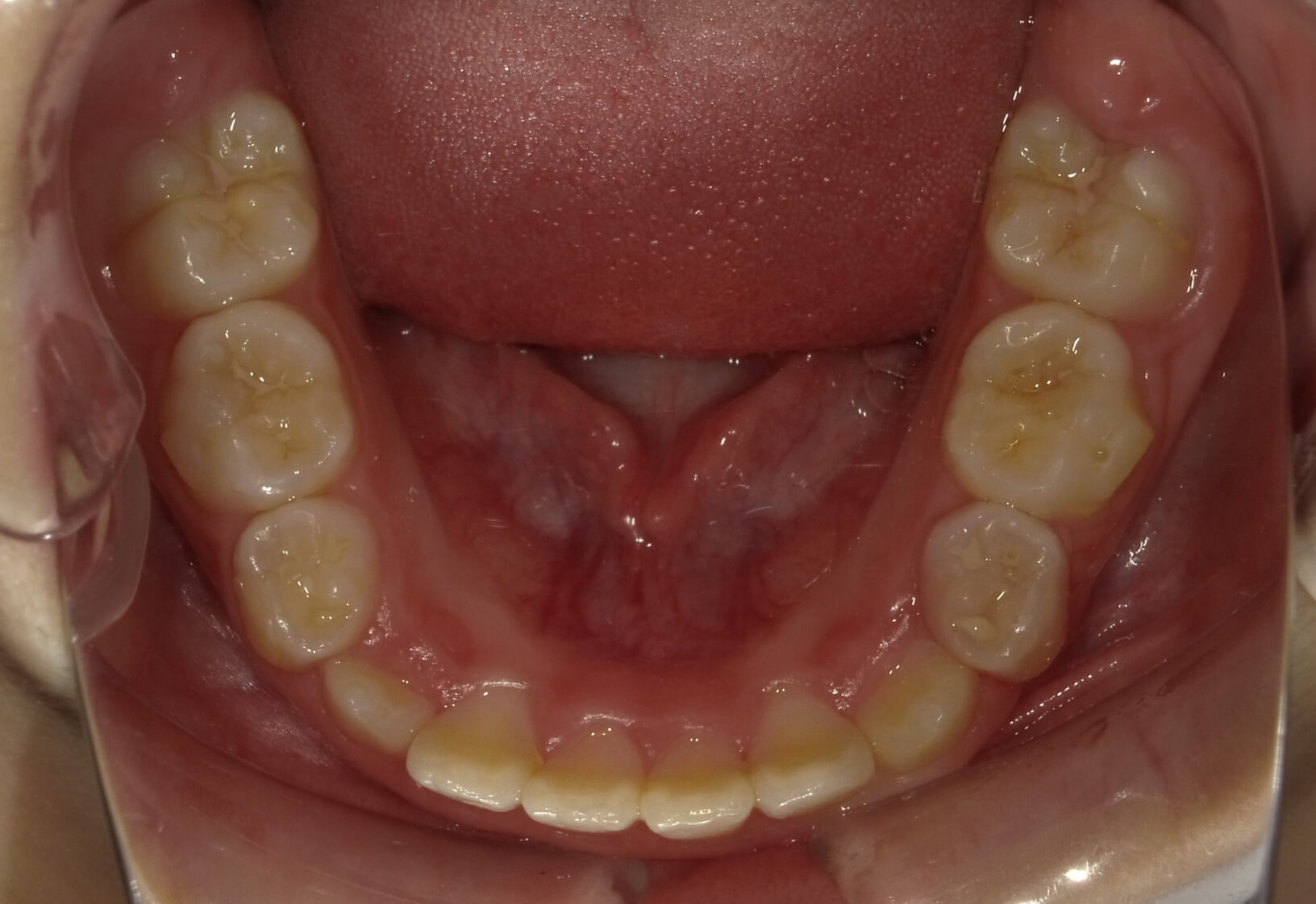 施術後の口内写真05