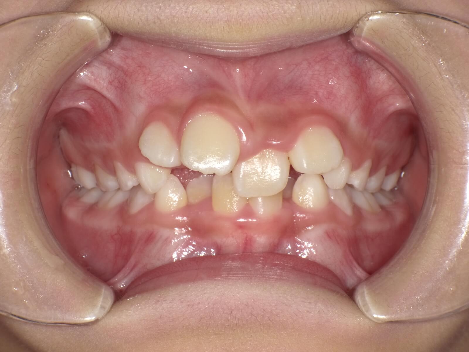 施術前の口内写真01