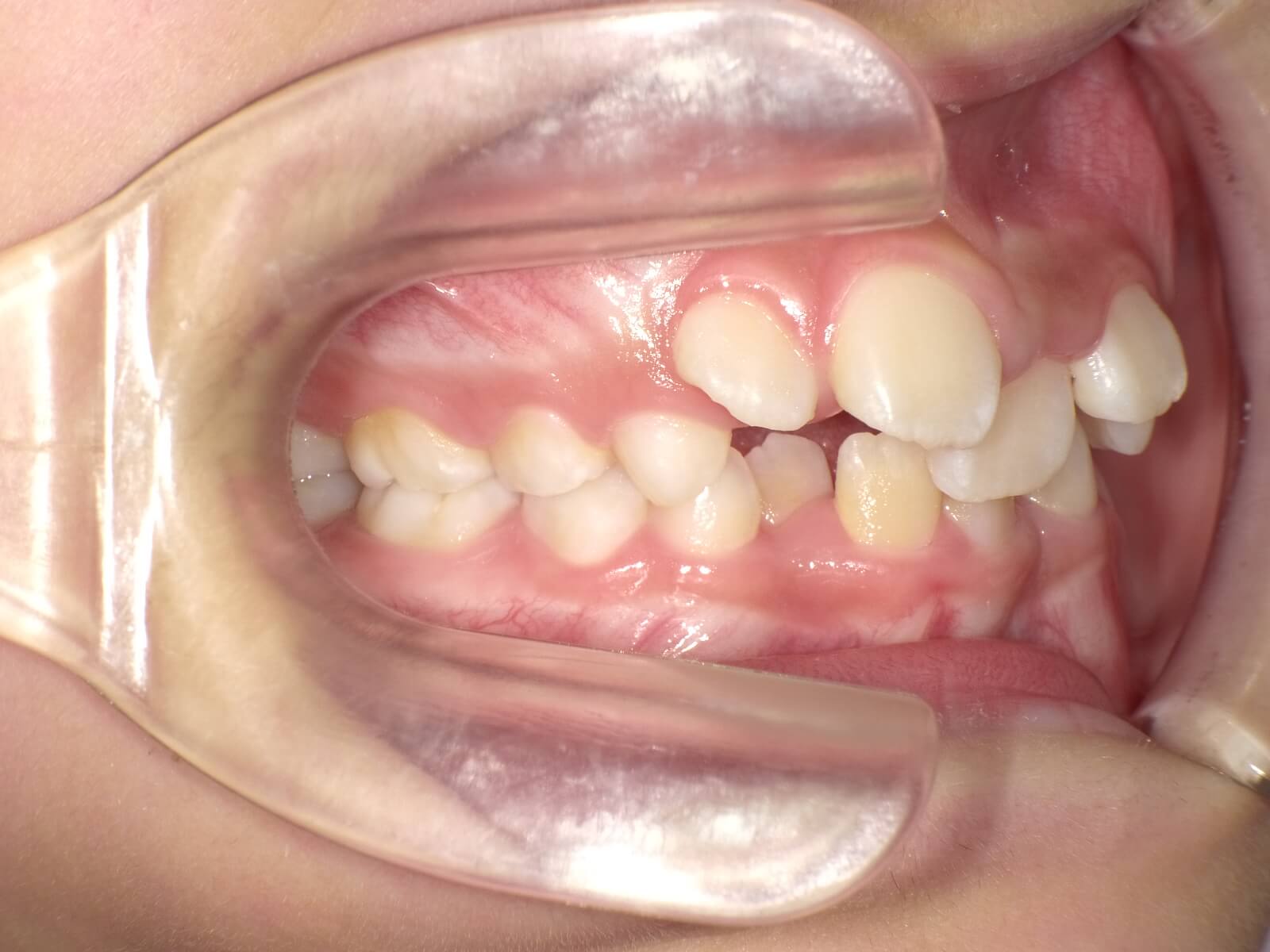 施術前の口内写真02