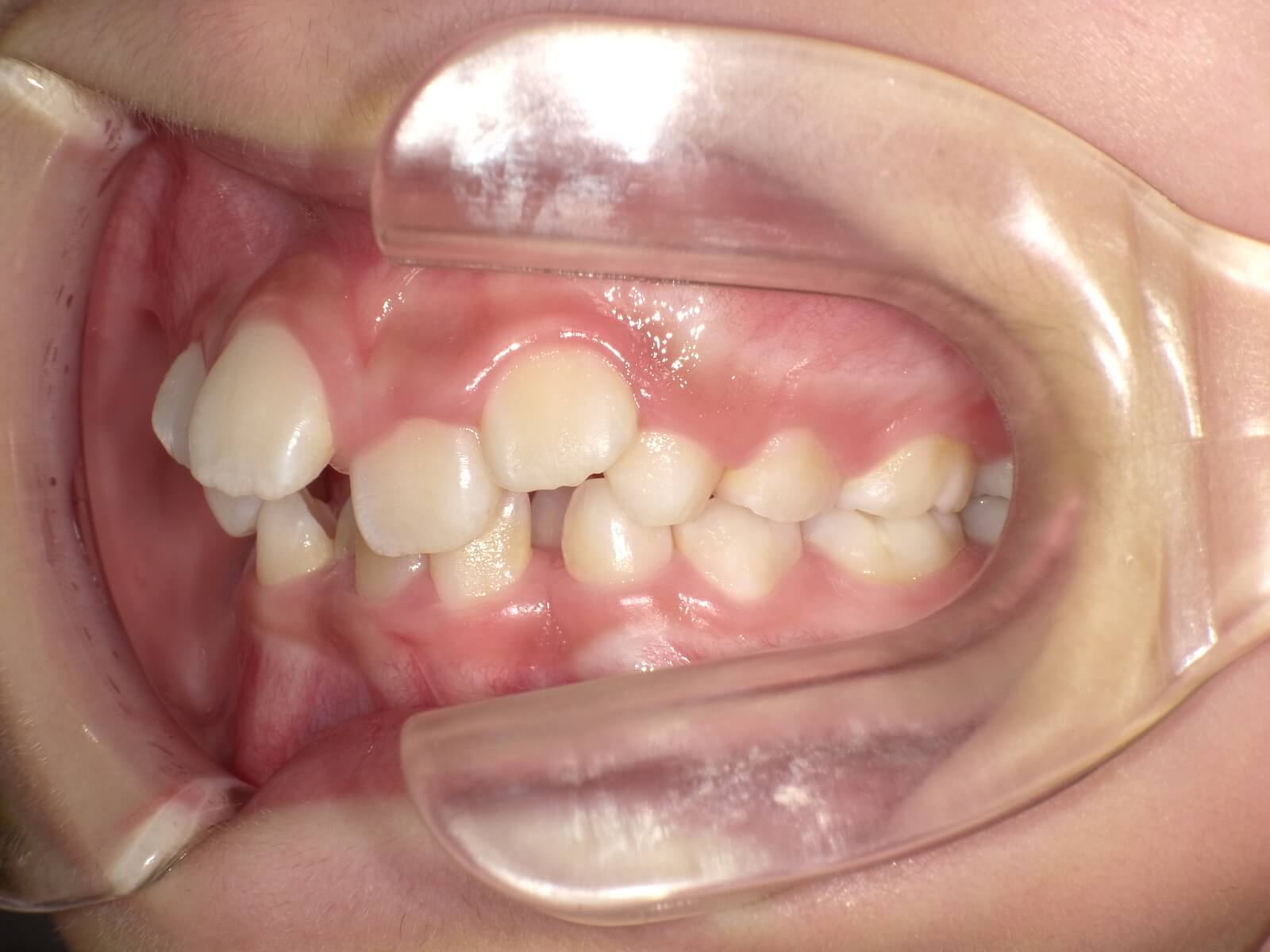 施術前の口内写真03