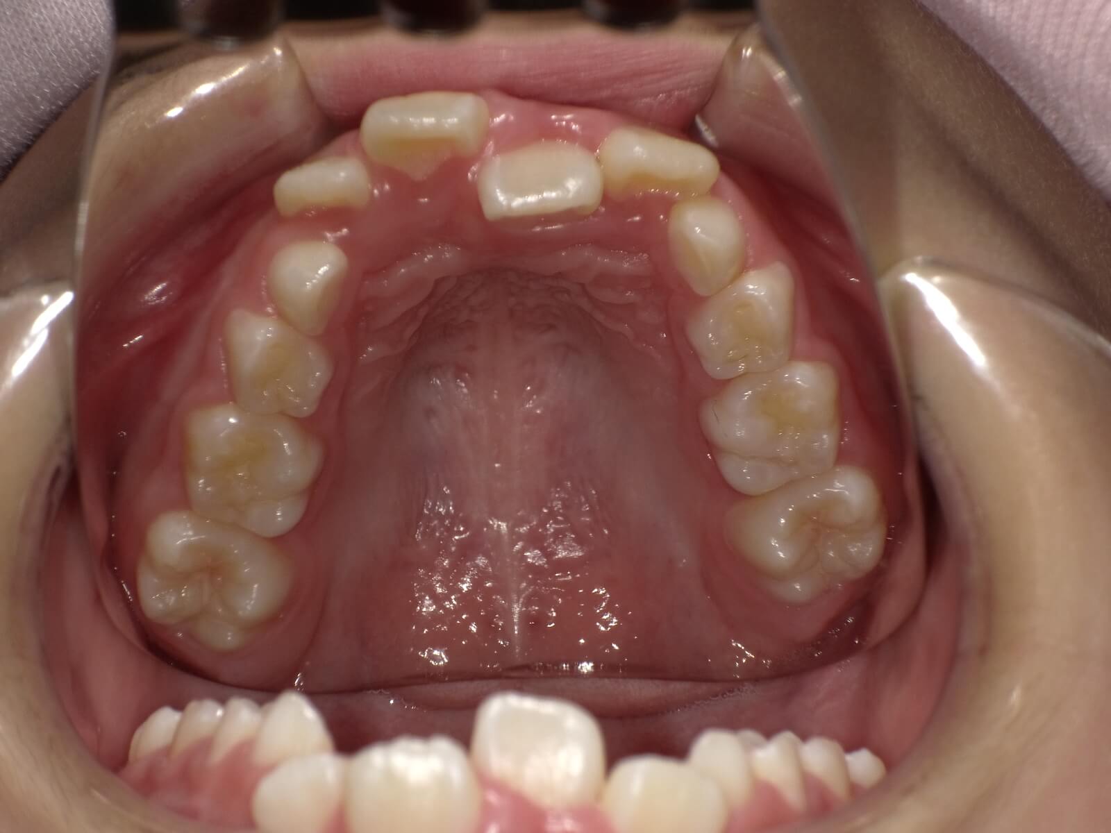 施術前の口内写真04