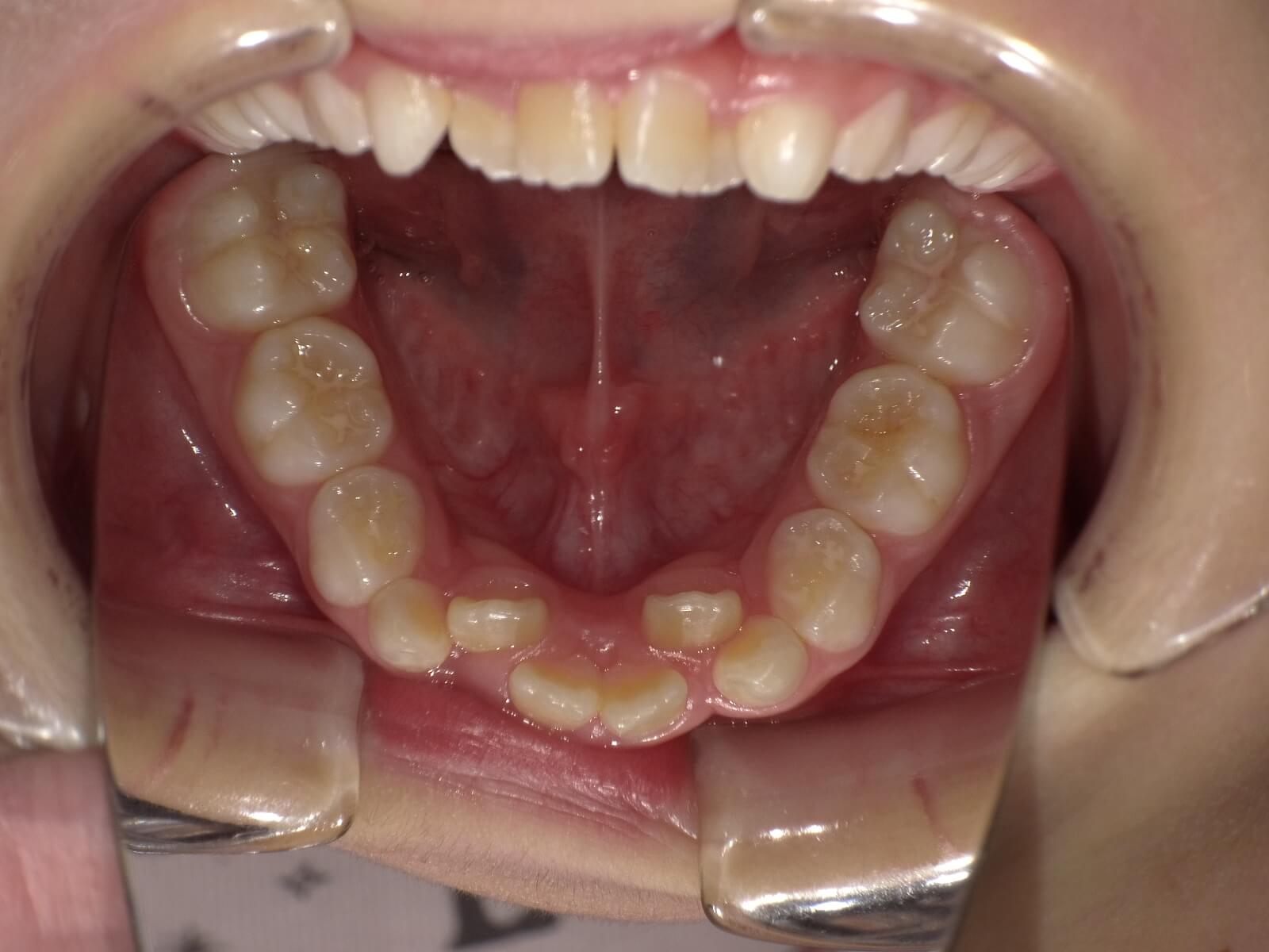 施術前の口内写真05