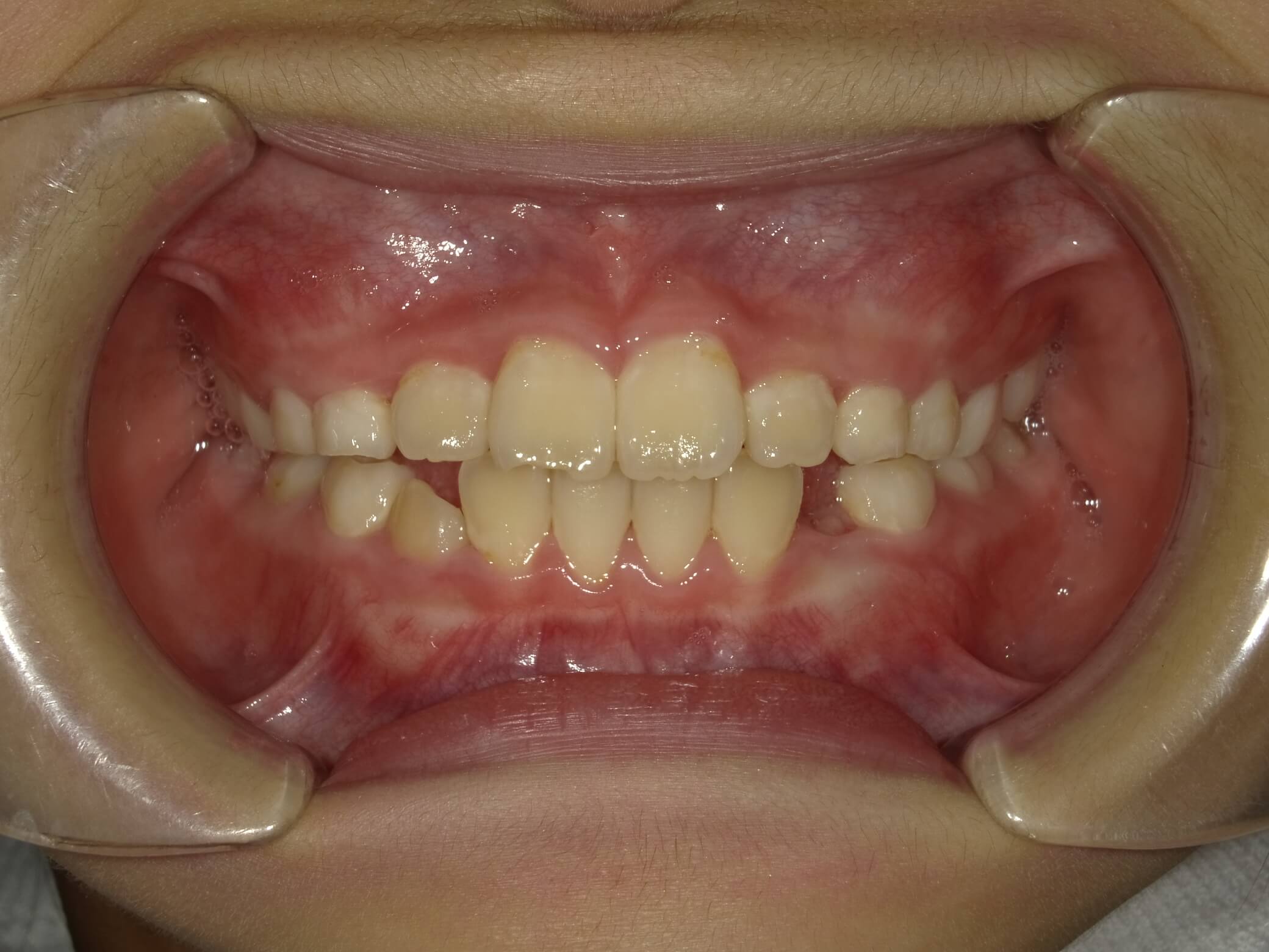 施術後の口内写真01