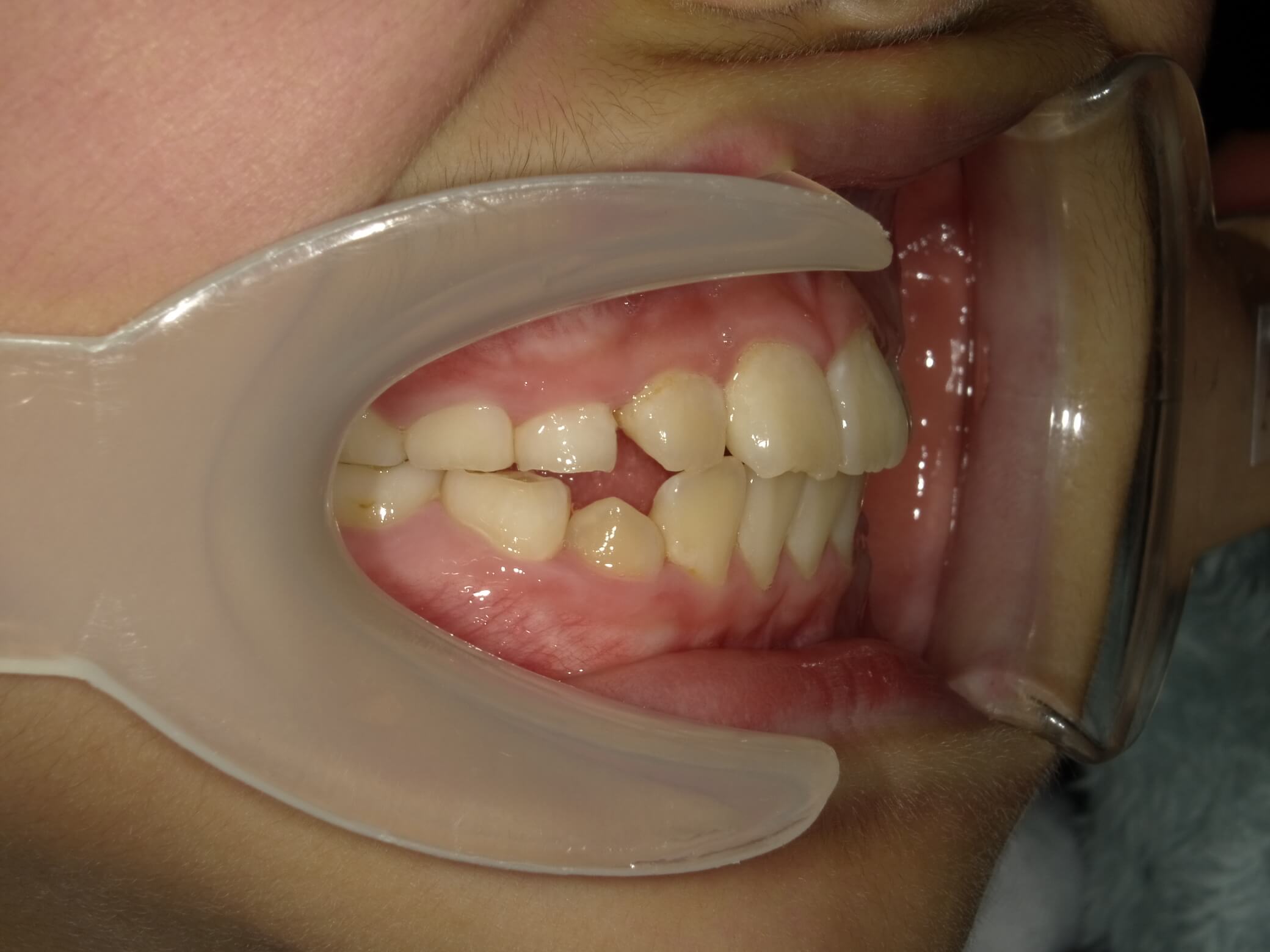 施術後の口内写真02
