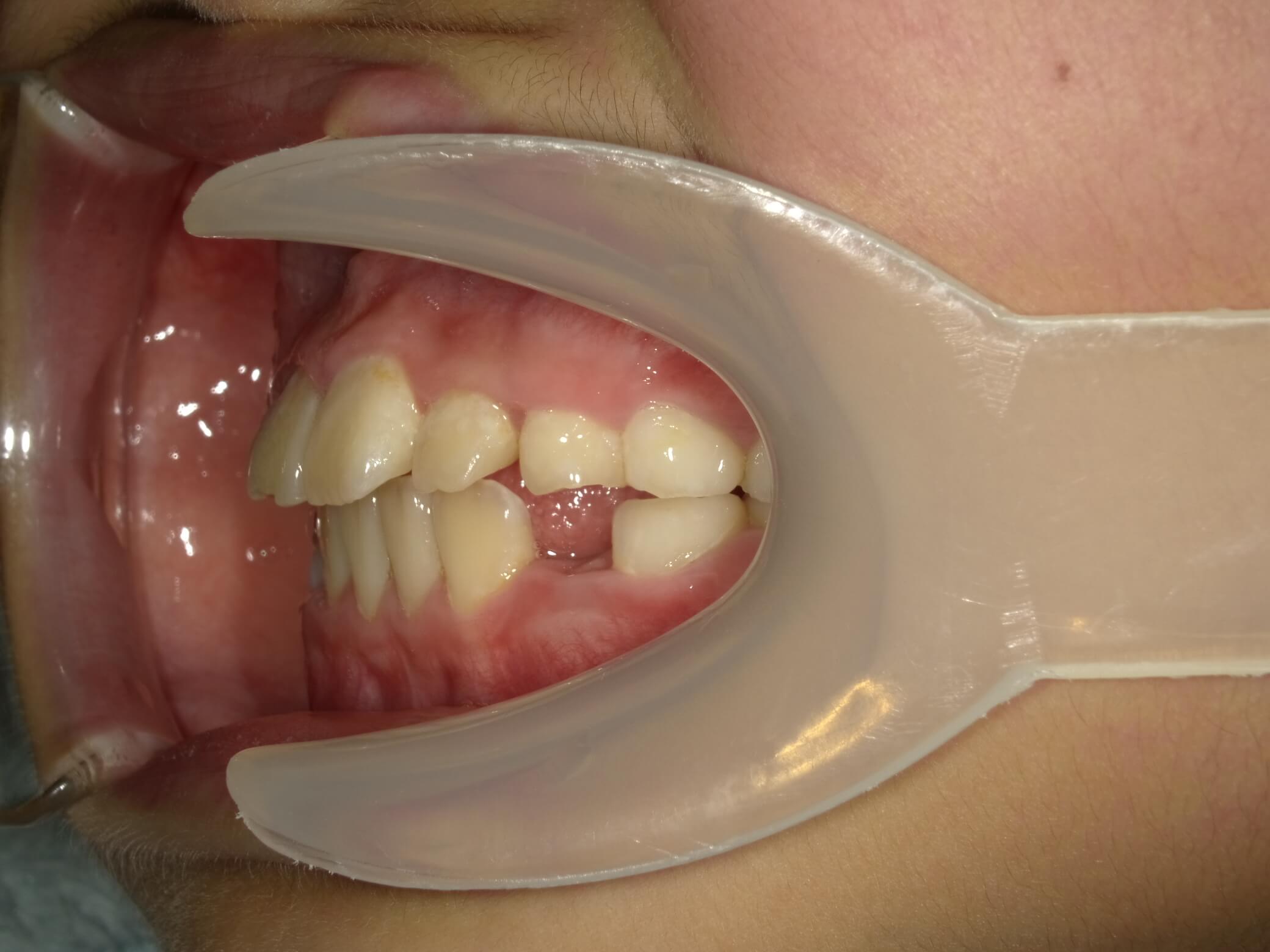 施術後の口内写真03