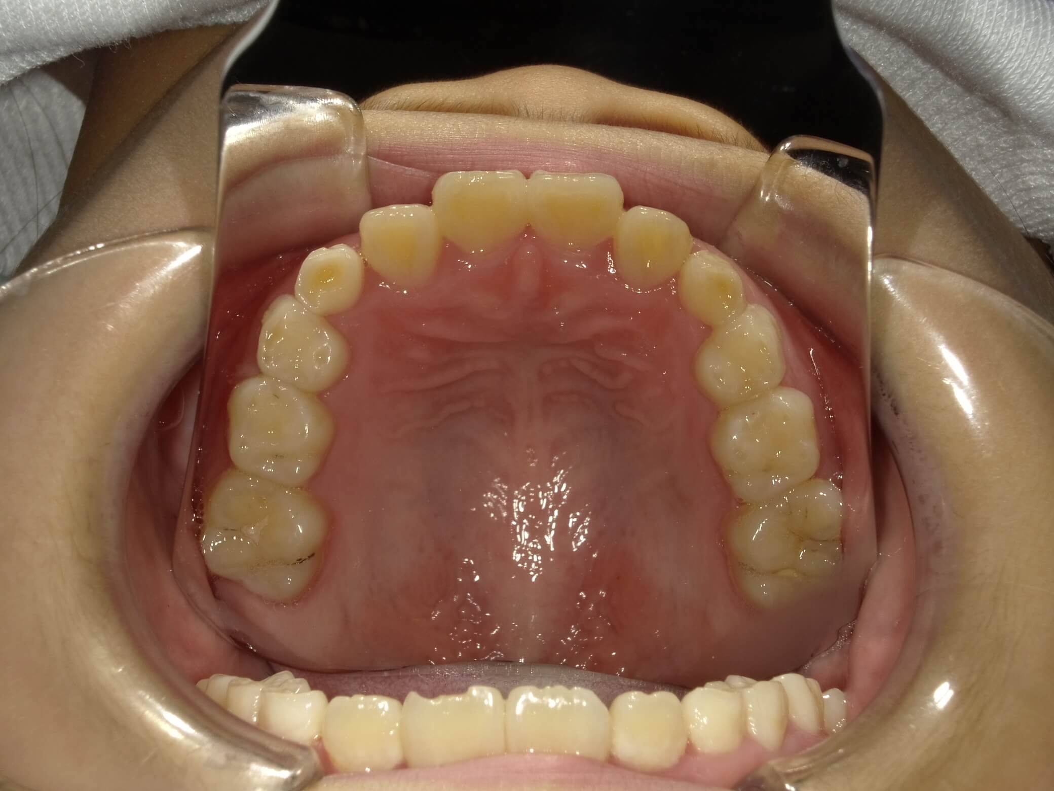 施術後の口内写真04