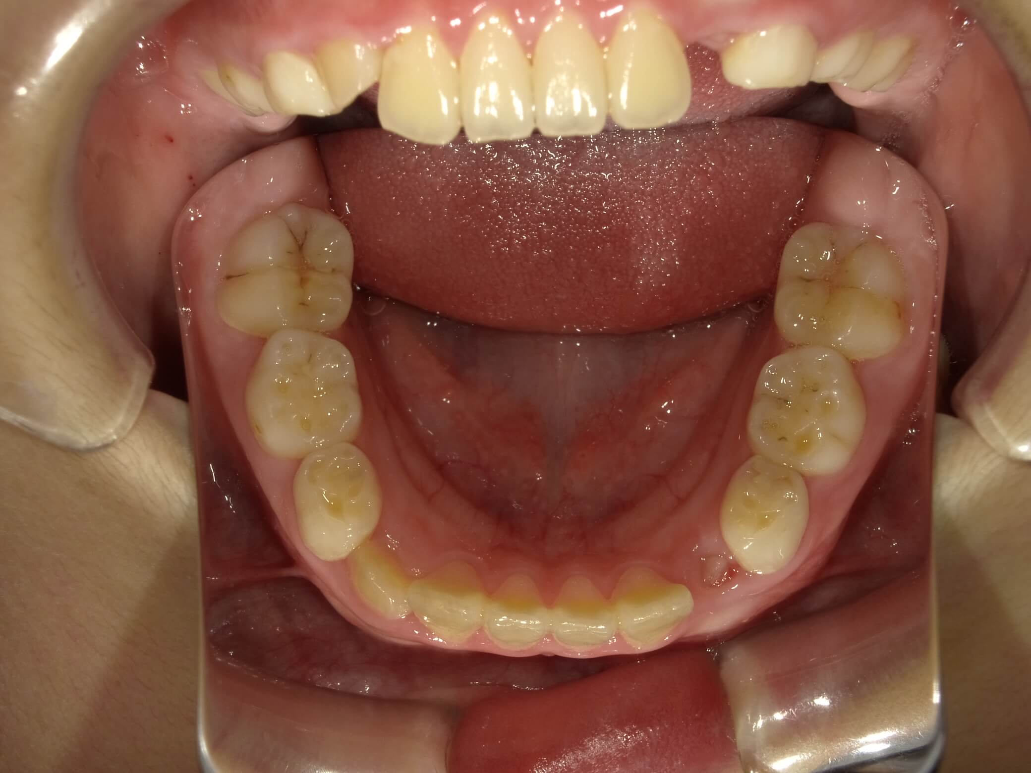 施術後の口内写真05