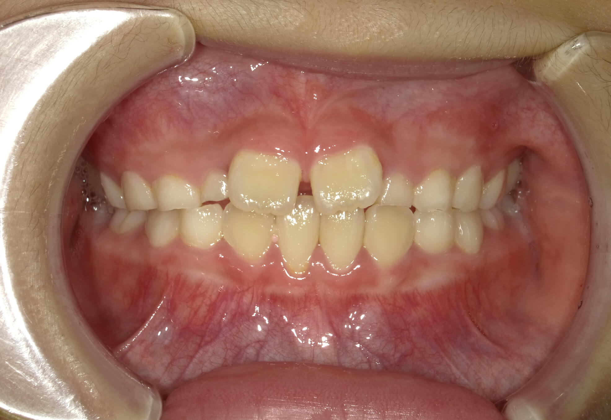 施術前の口内写真01