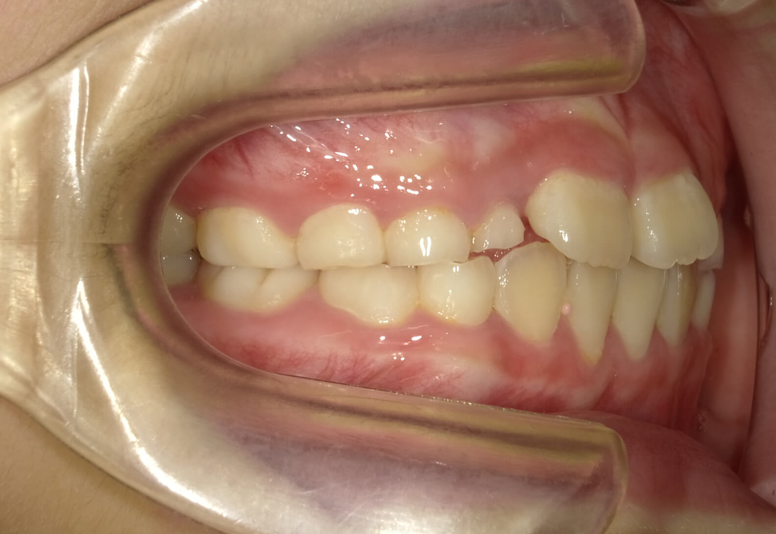 施術前の口内写真02