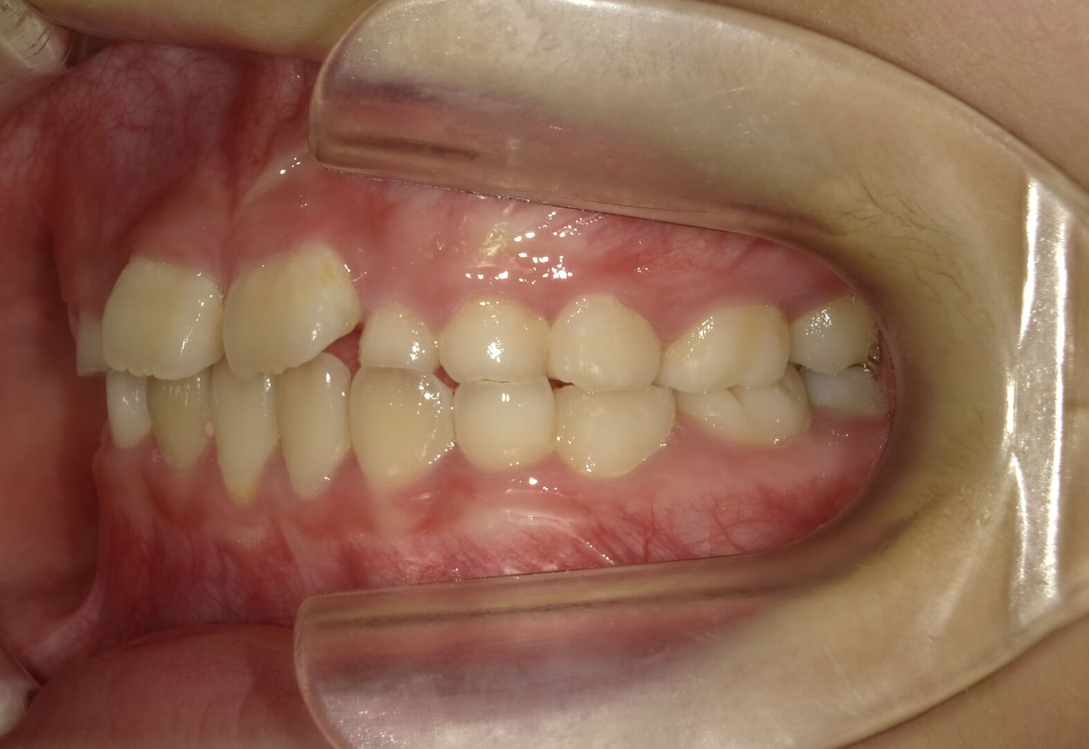 施術前の口内写真03