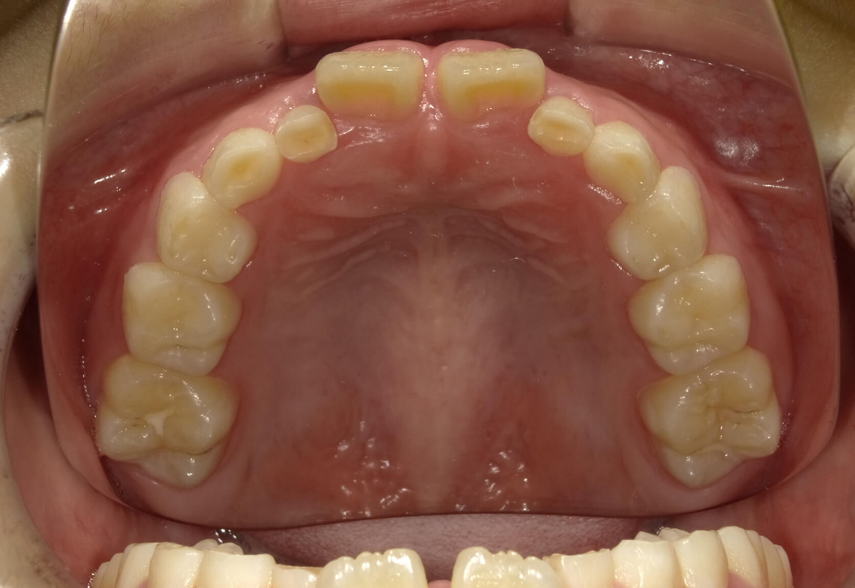 施術前の口内写真04