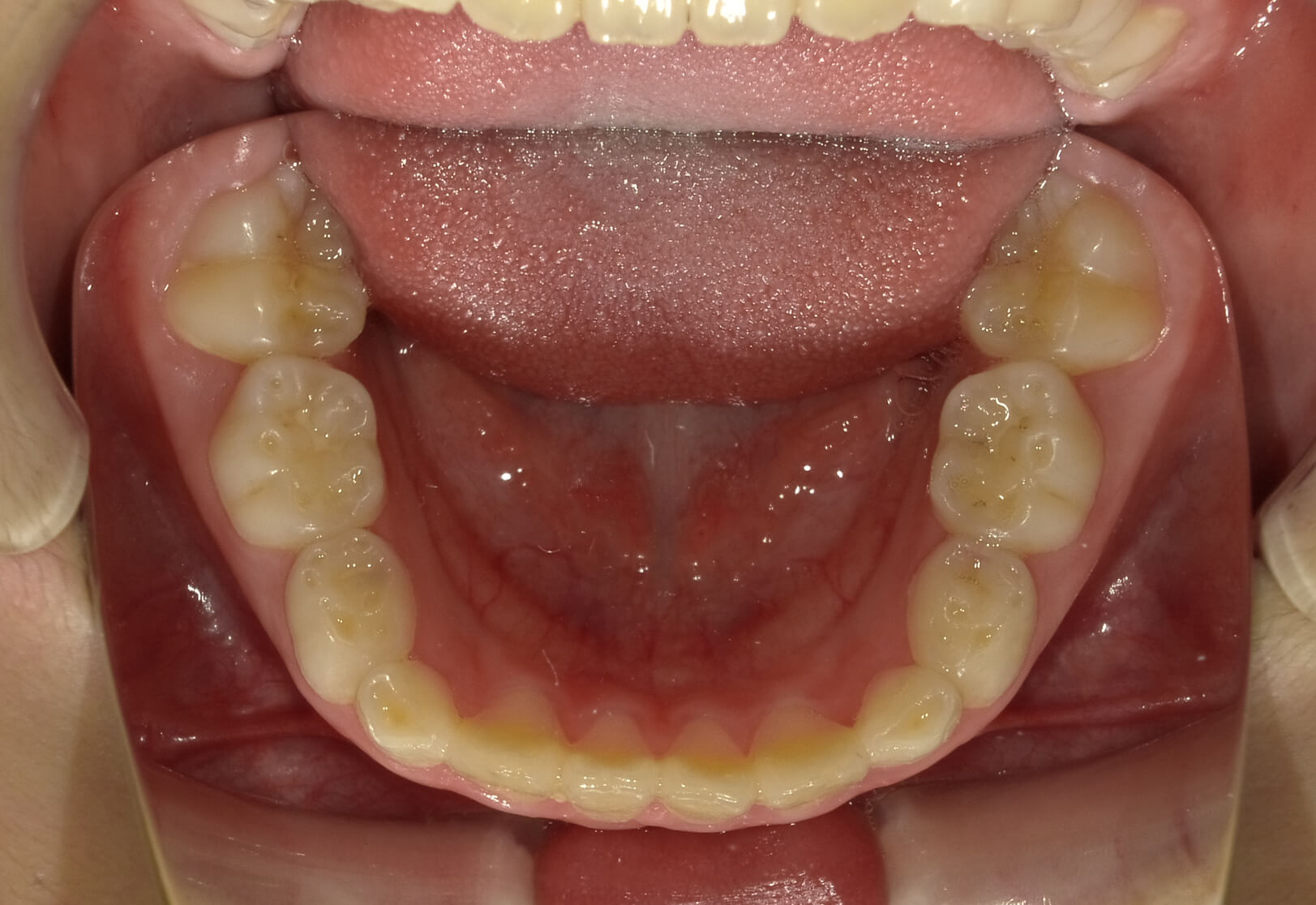 施術前の口内写真05