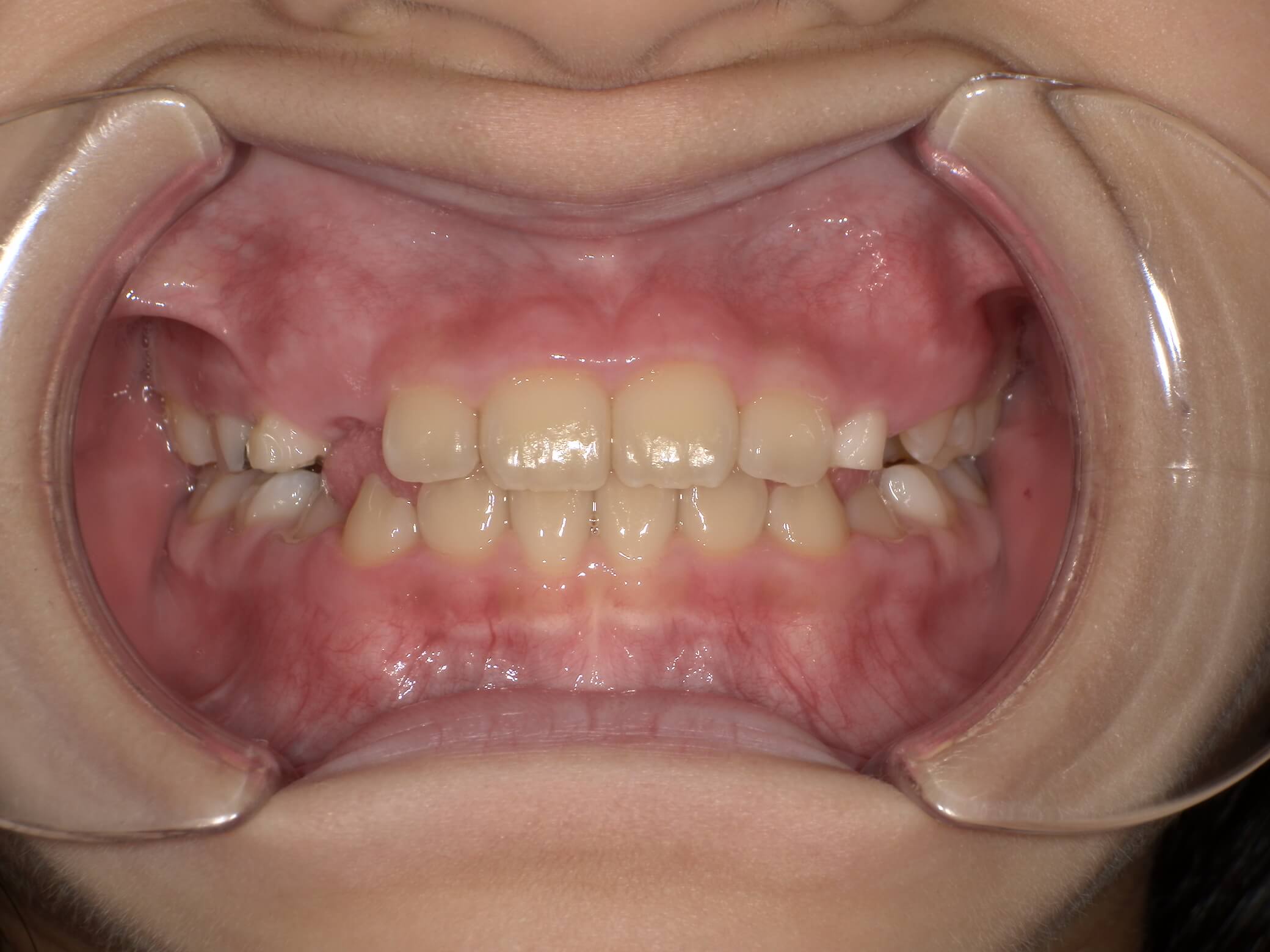 施術後の口内写真01