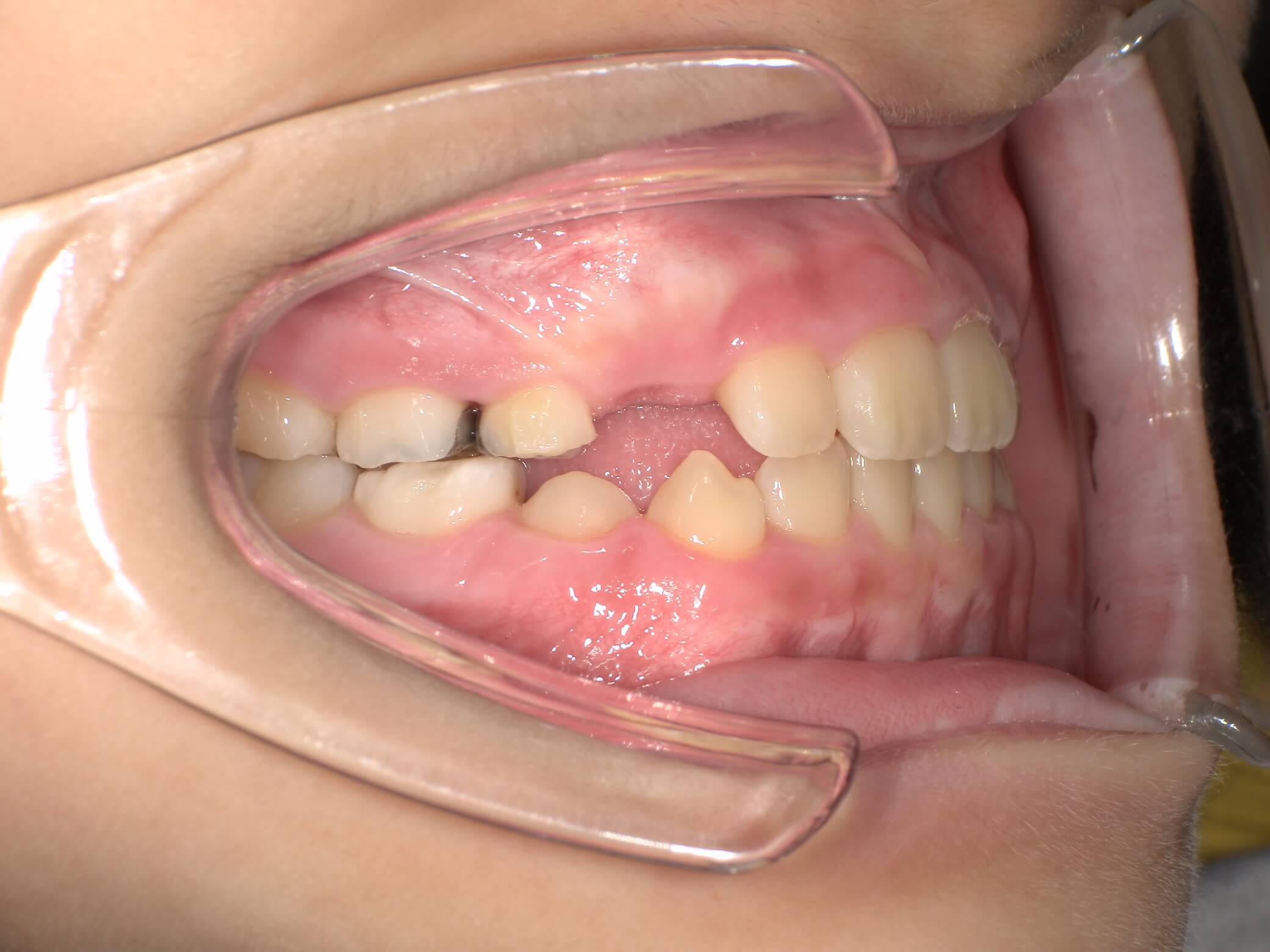 施術後の口内写真02