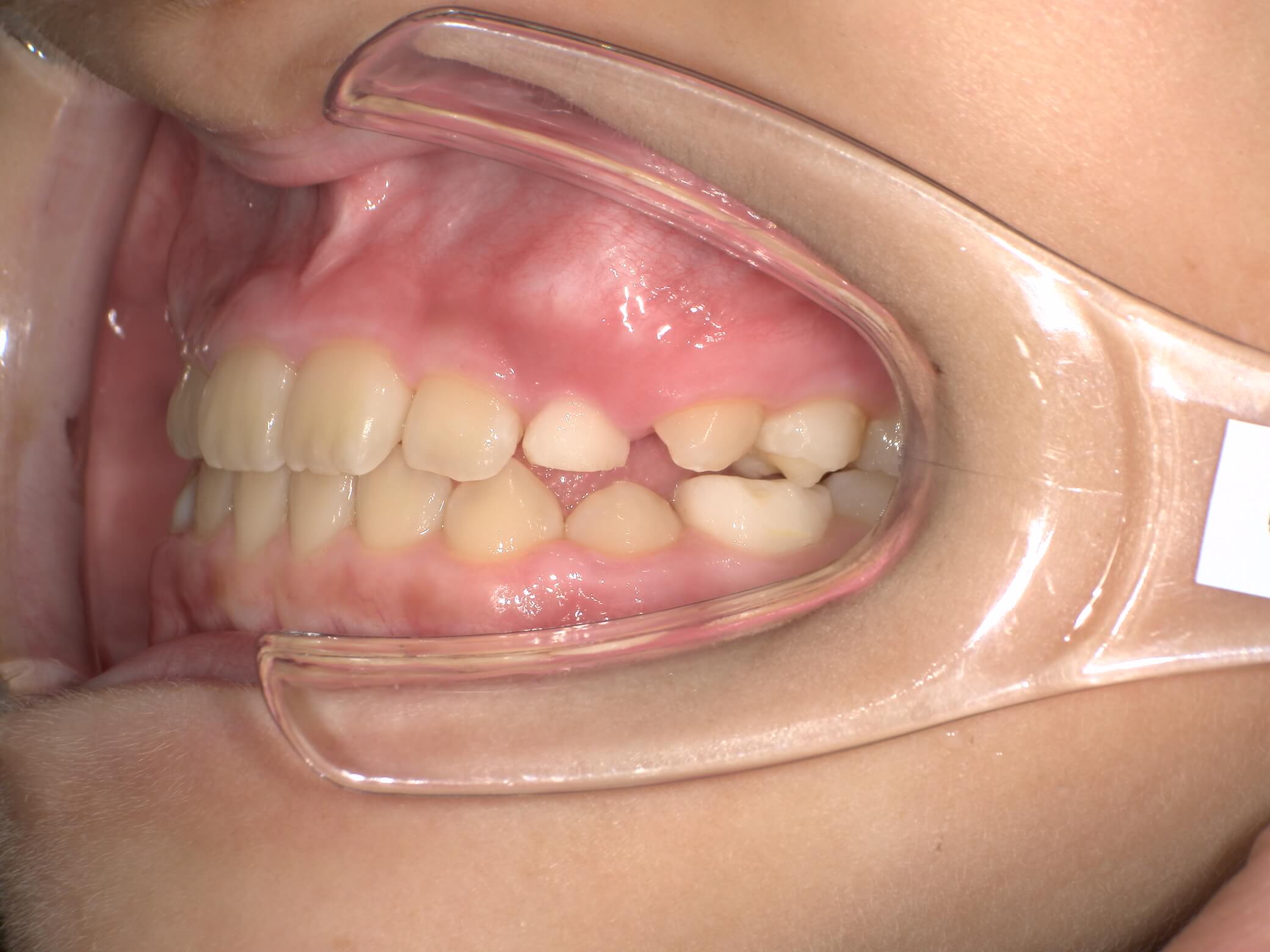 施術後の口内写真03