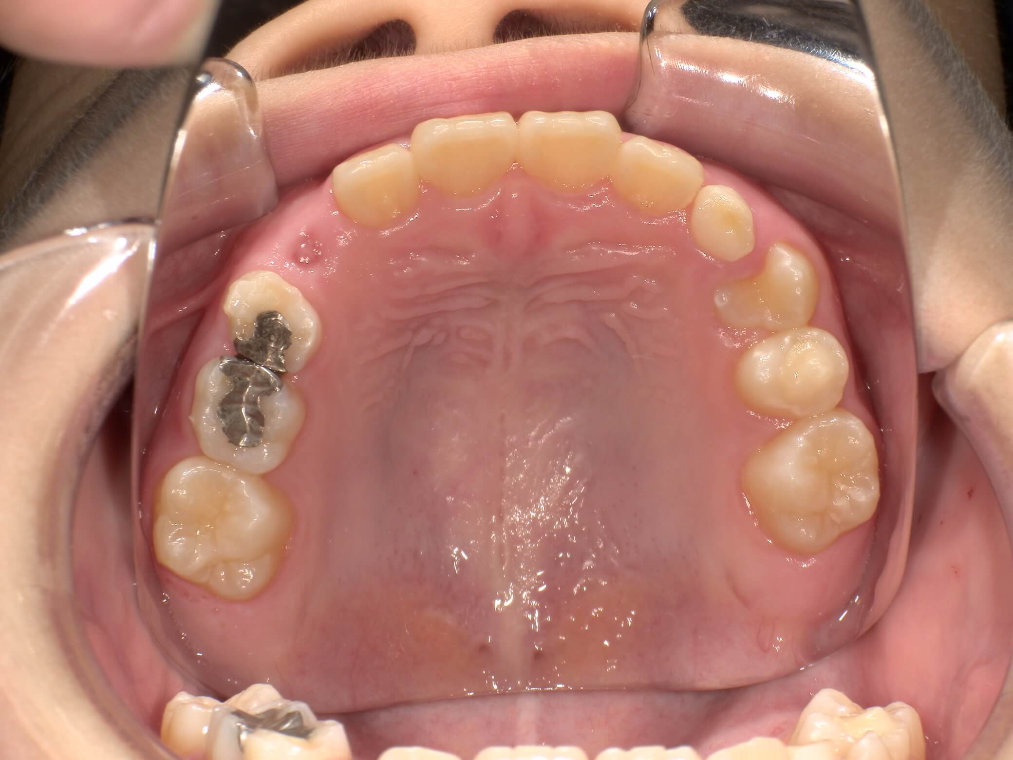 施術後の口内写真04