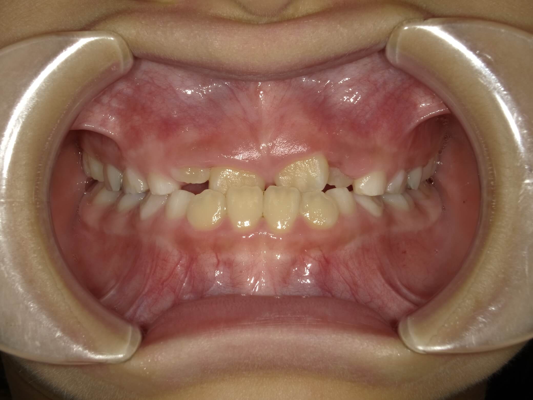 施術前の口内写真01