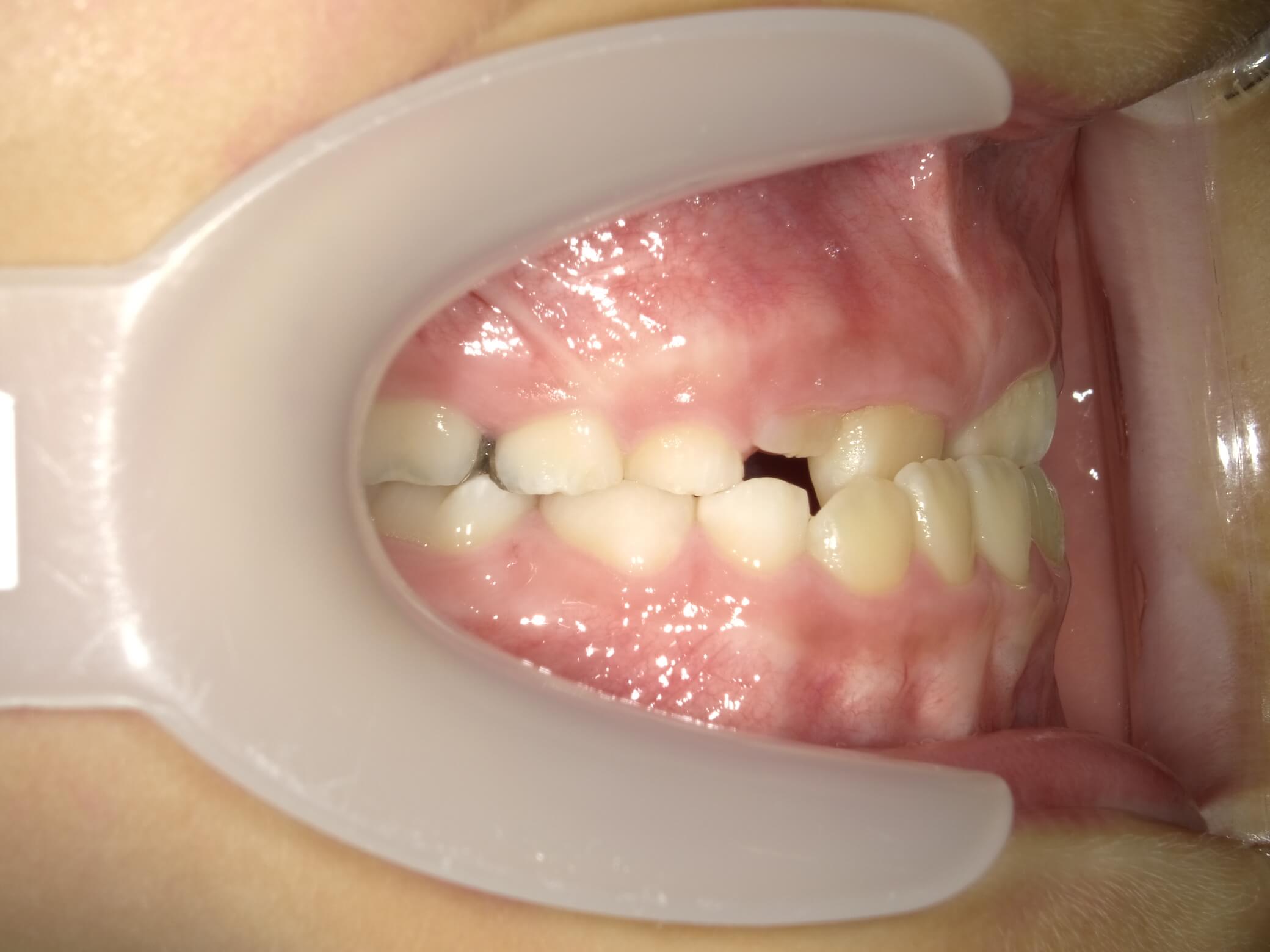 施術前の口内写真02