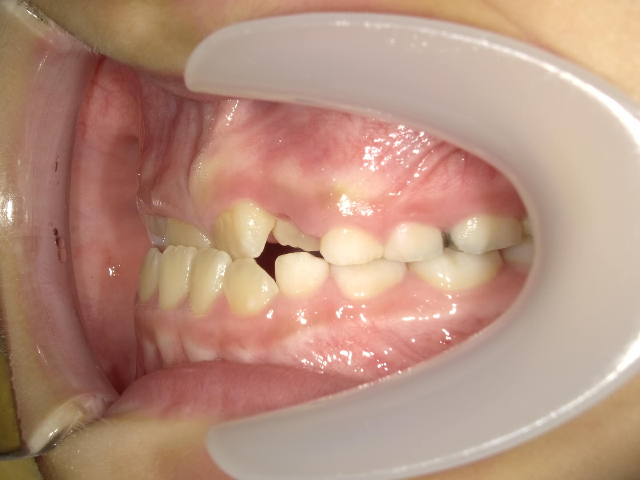 施術前の口内写真03