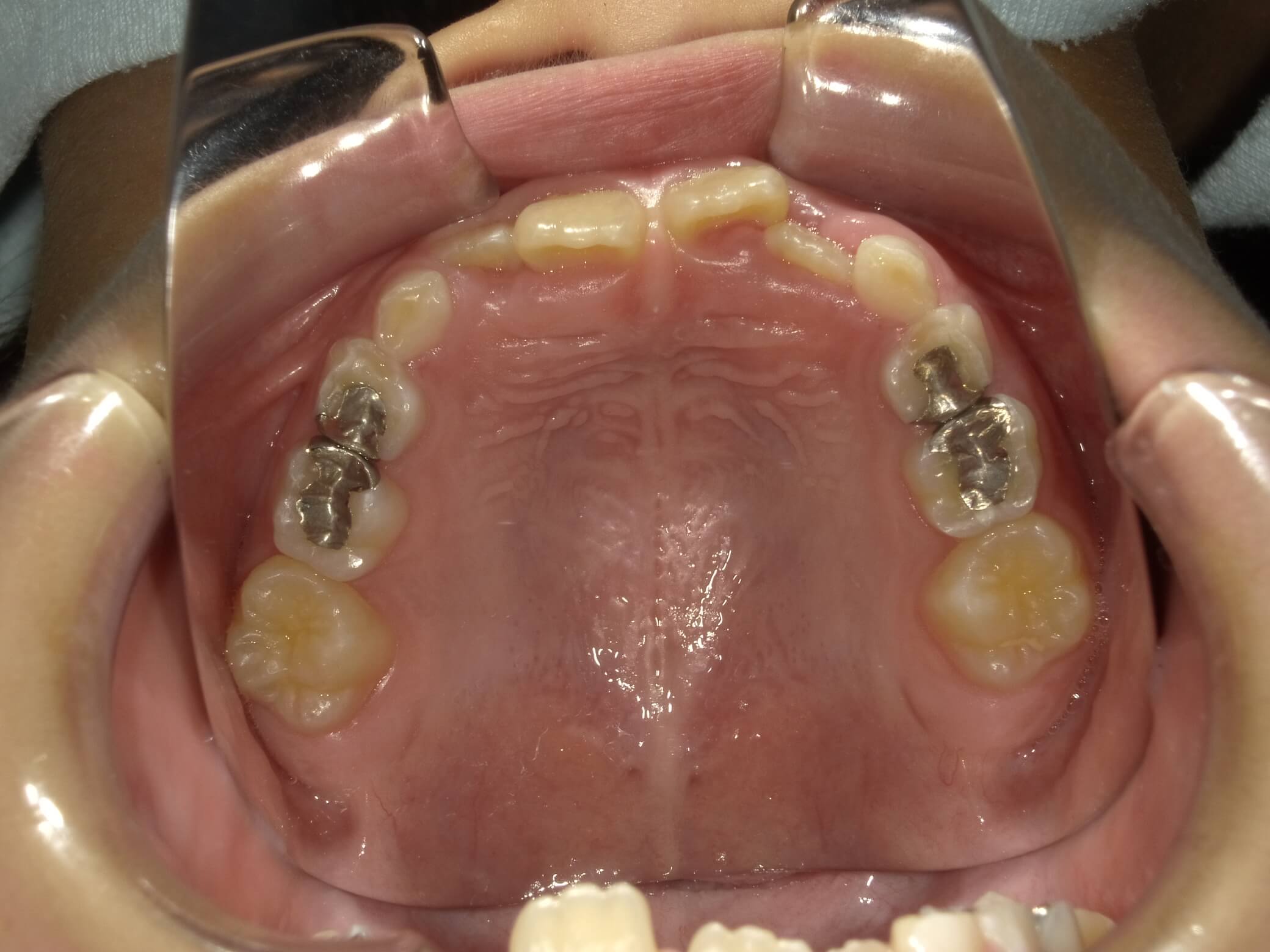 施術前の口内写真04