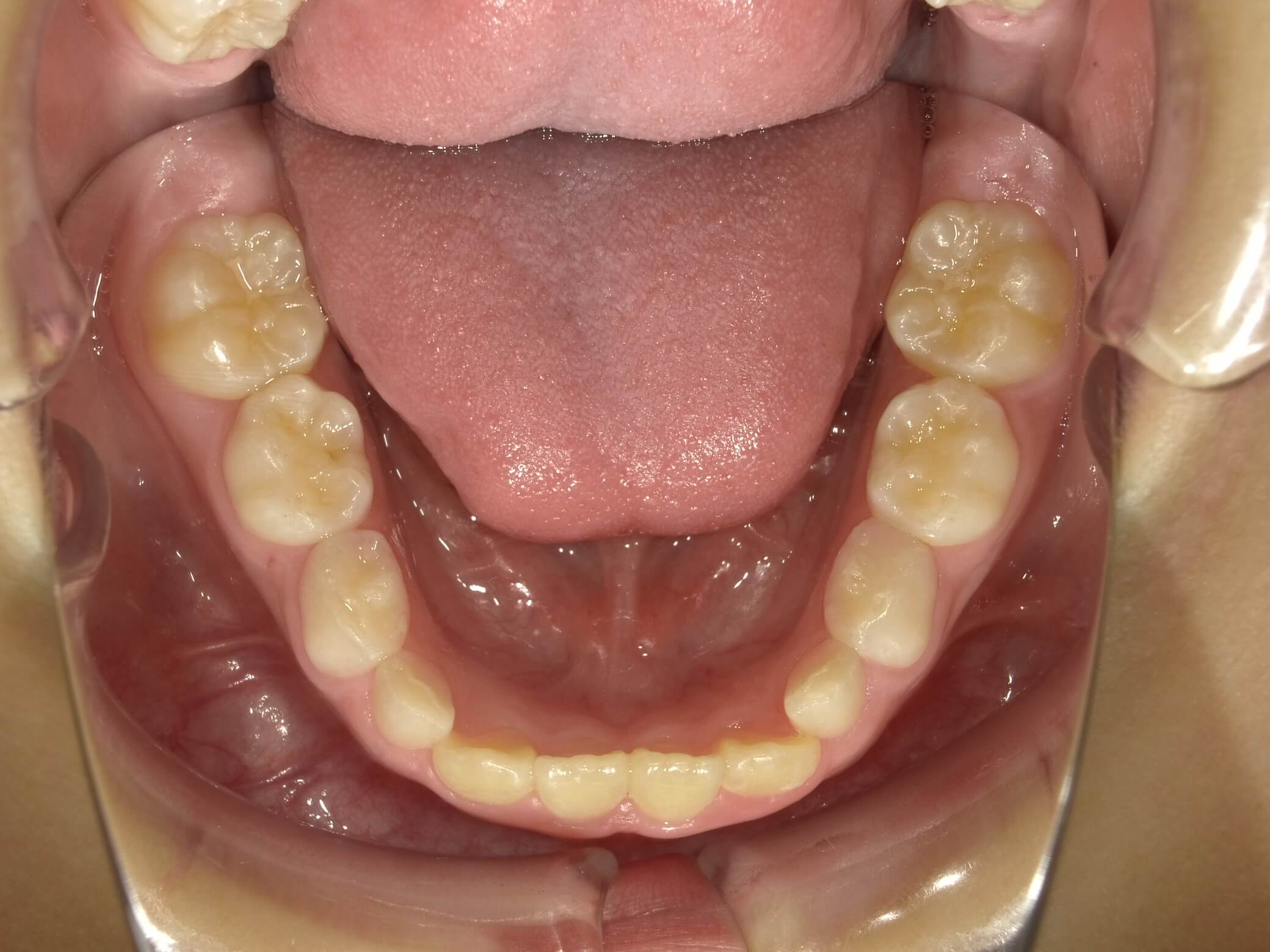 施術前の口内写真05