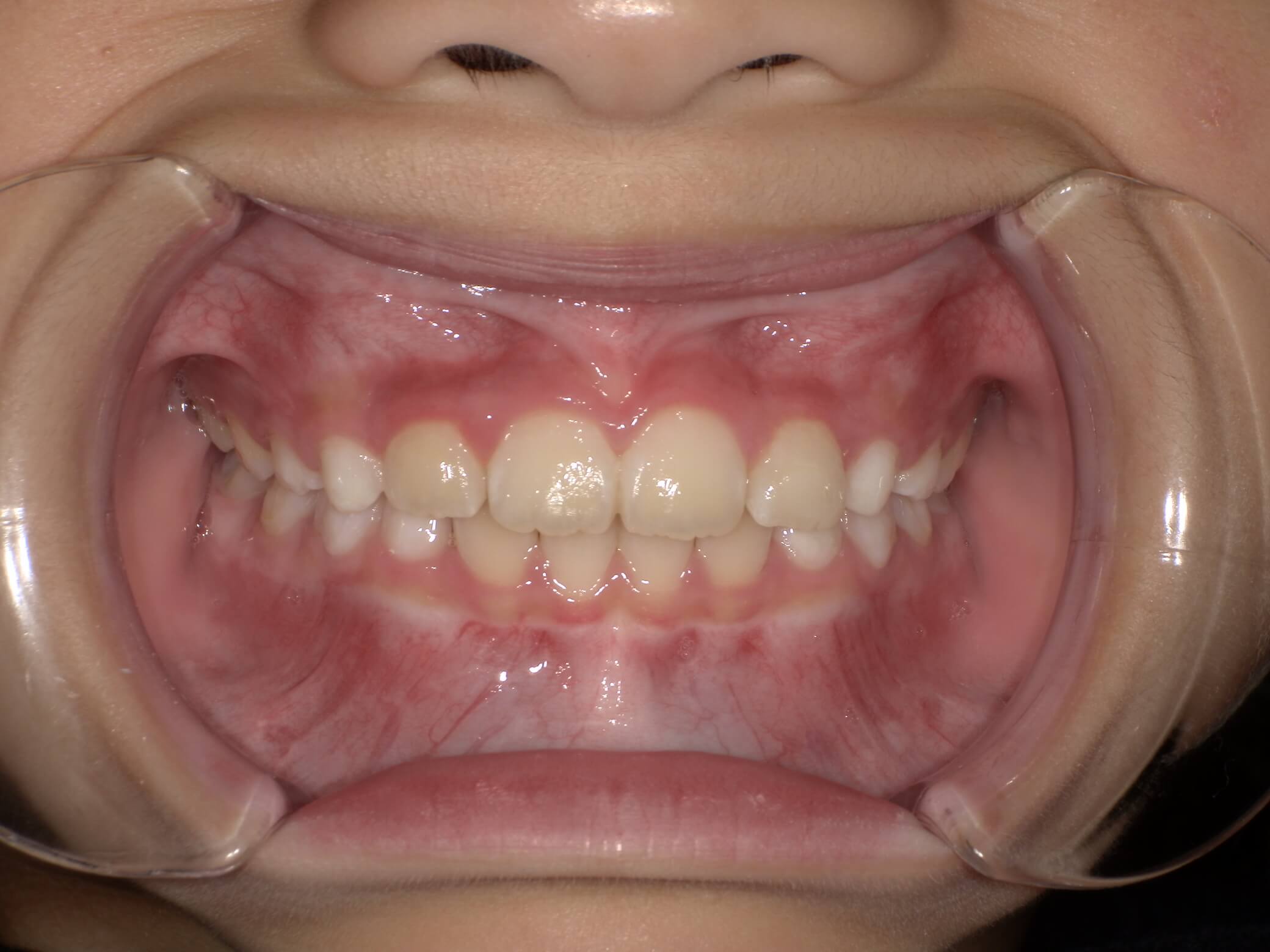 施術後の口内写真01