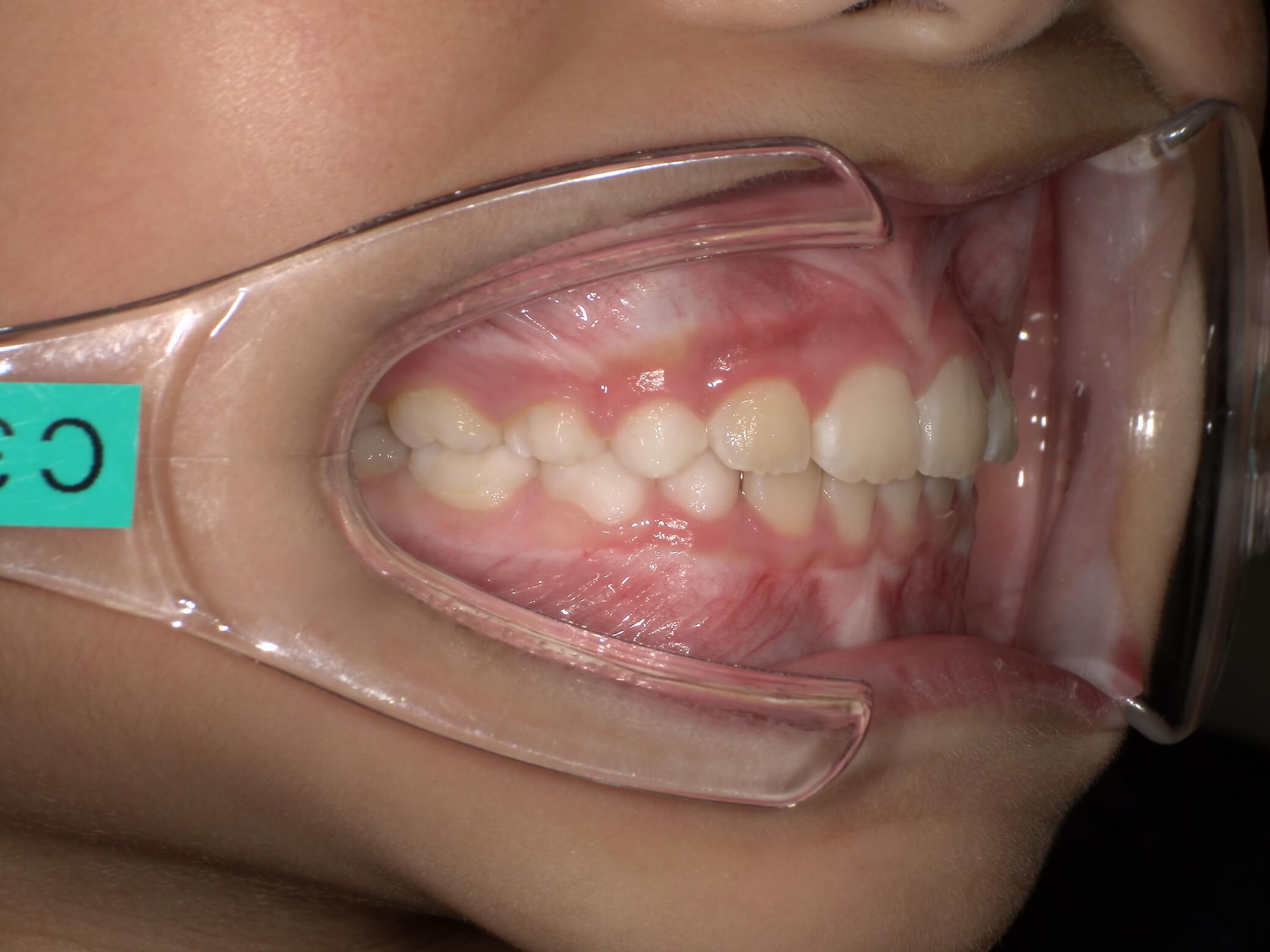 施術後の口内写真02