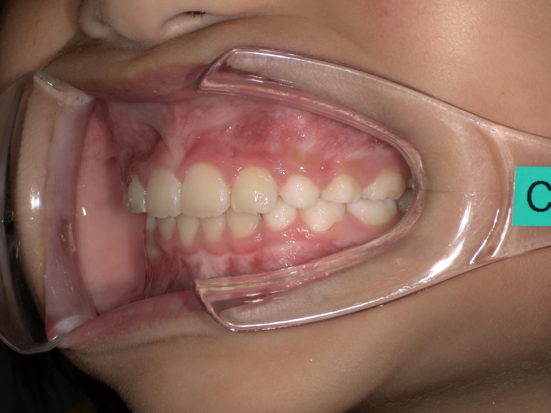 施術後の口内写真03