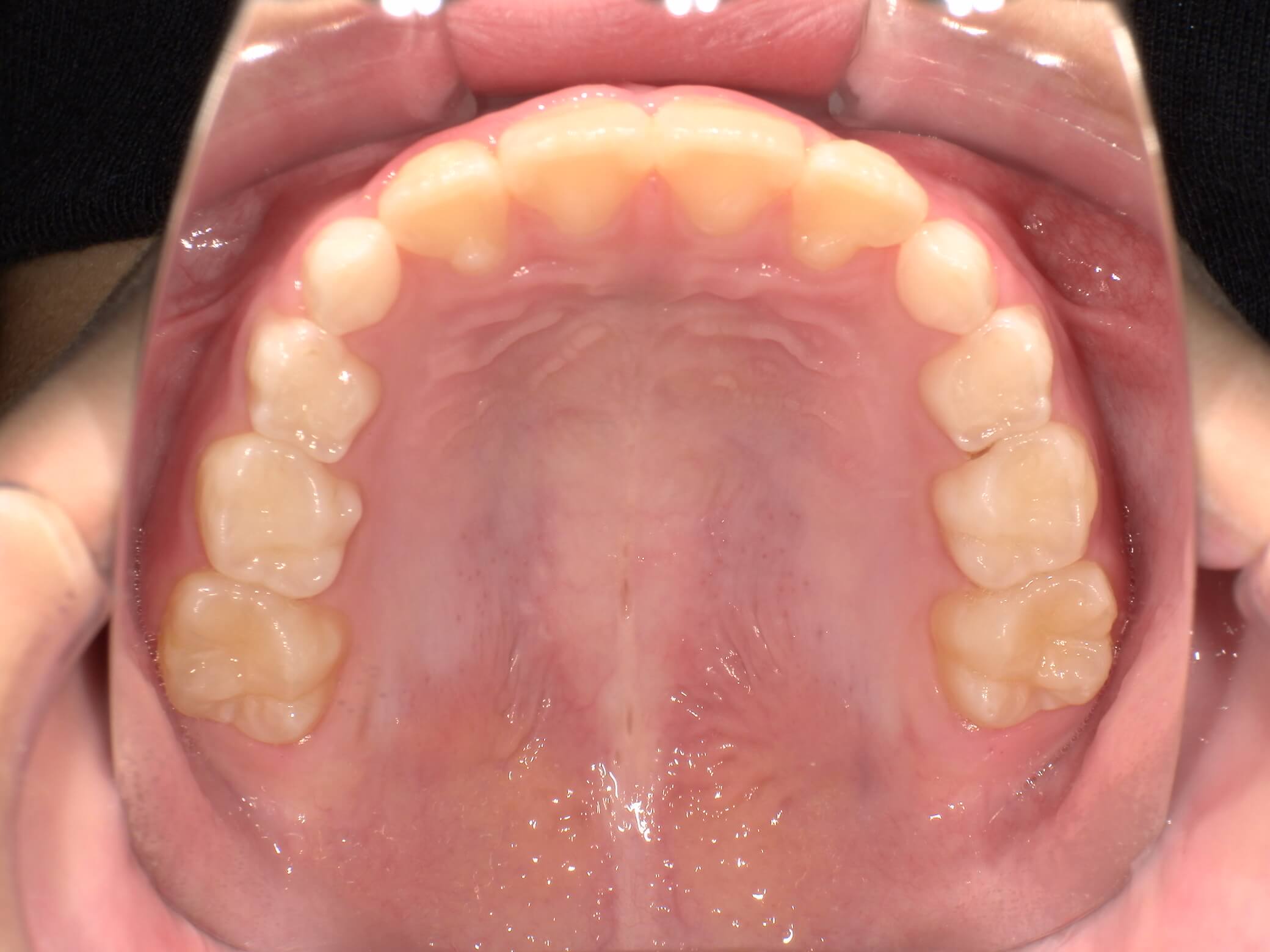 施術後の口内写真04