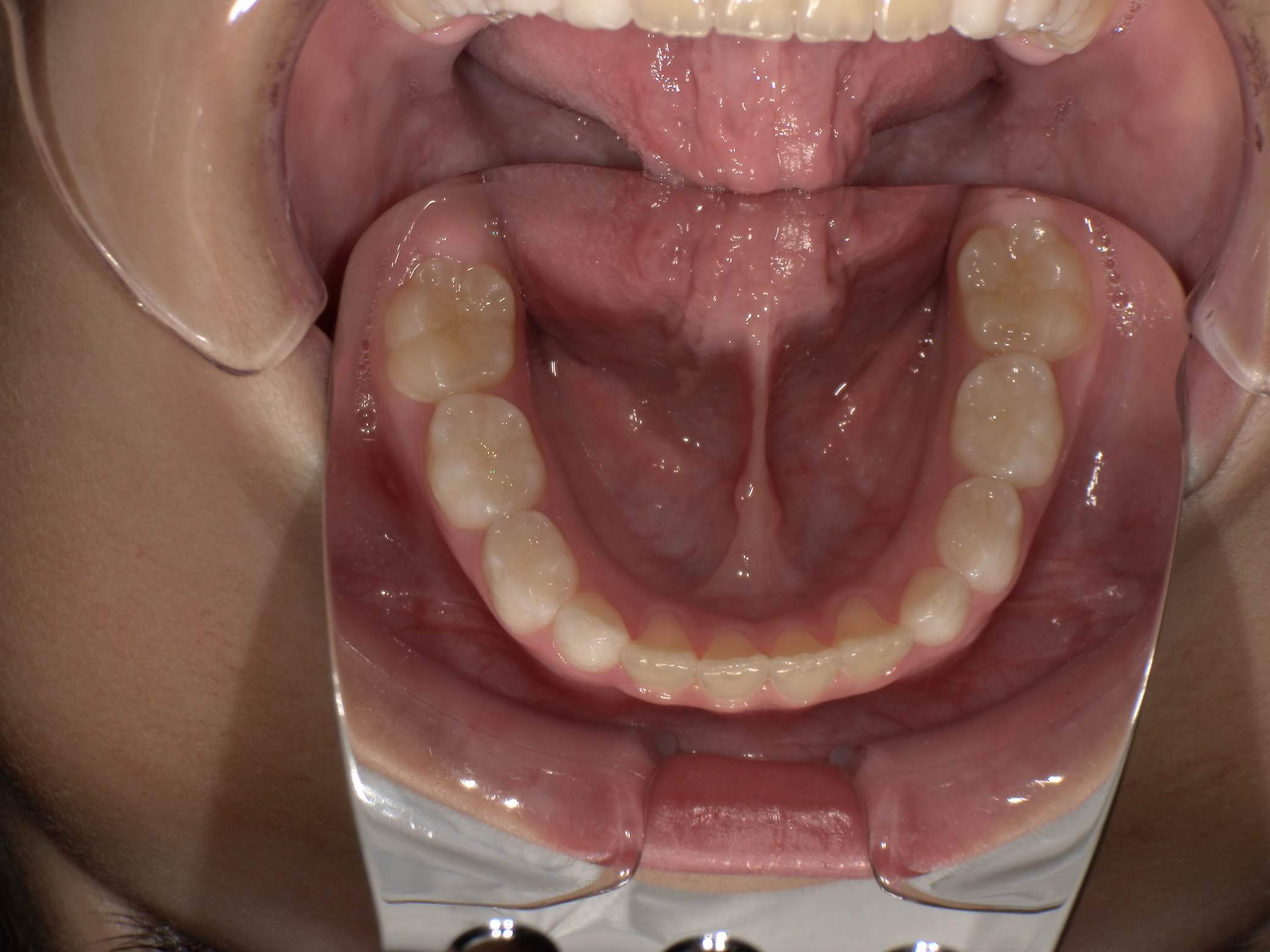 施術後の口内写真05