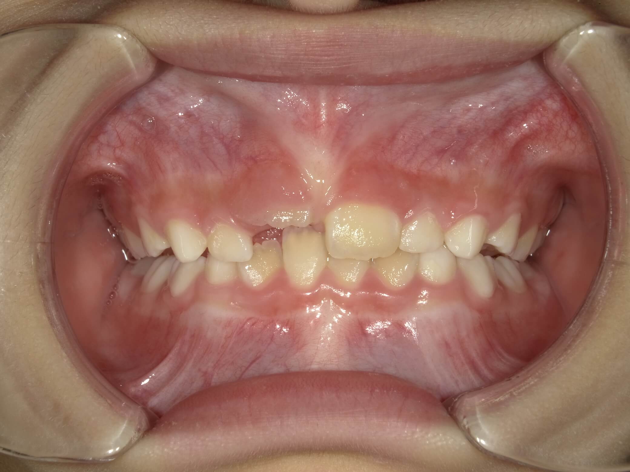施術前の口内写真01