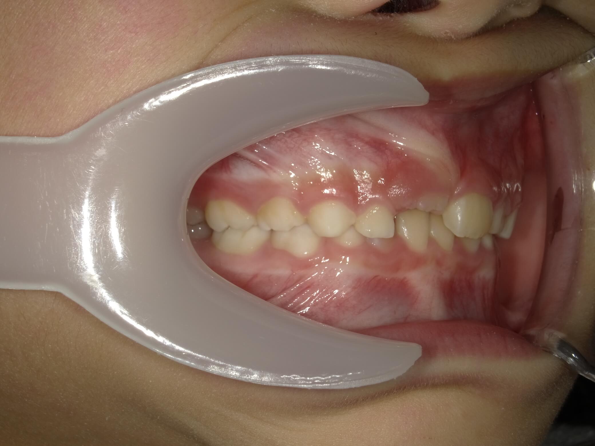 施術前の口内写真02