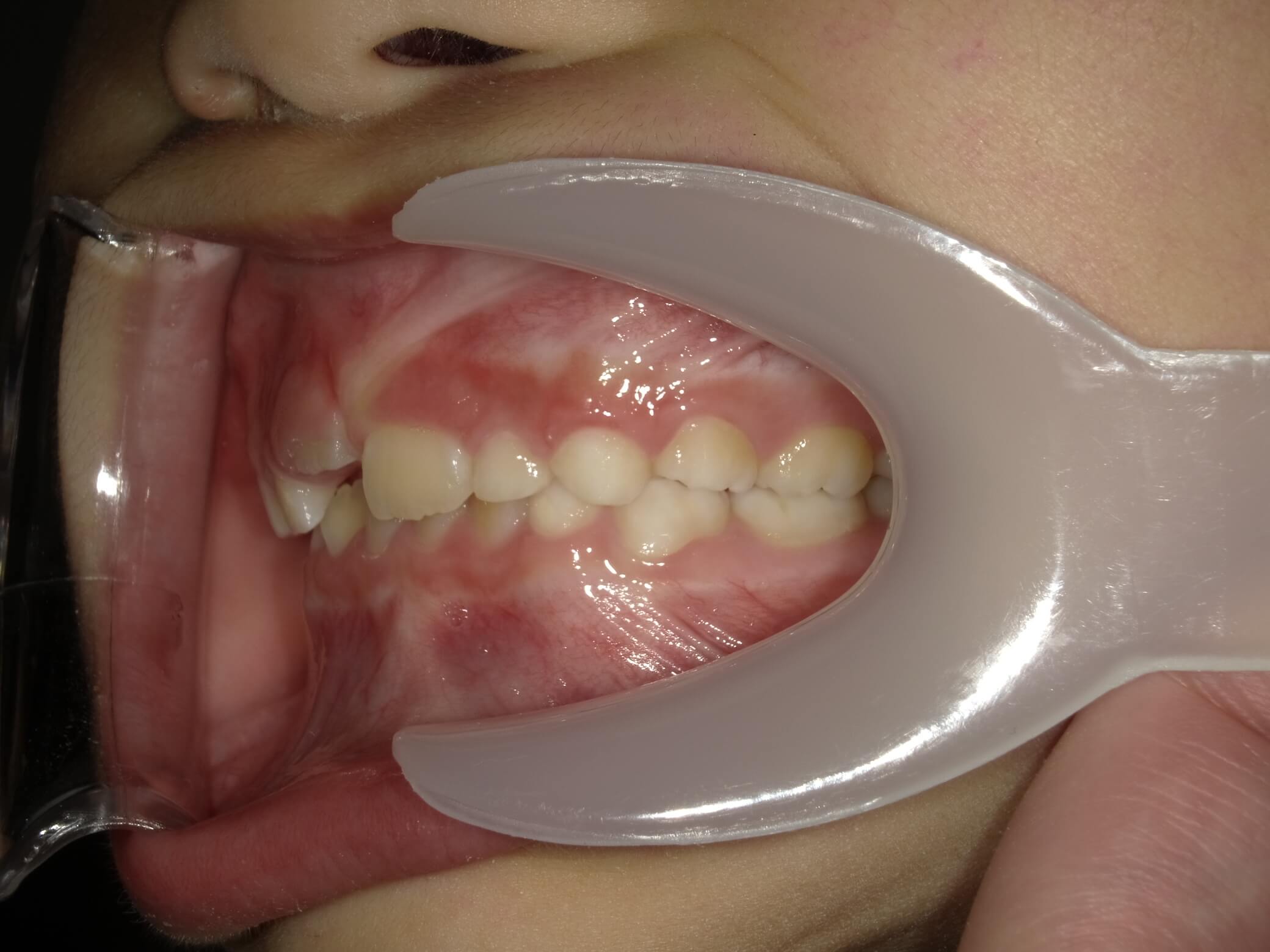 施術前の口内写真03