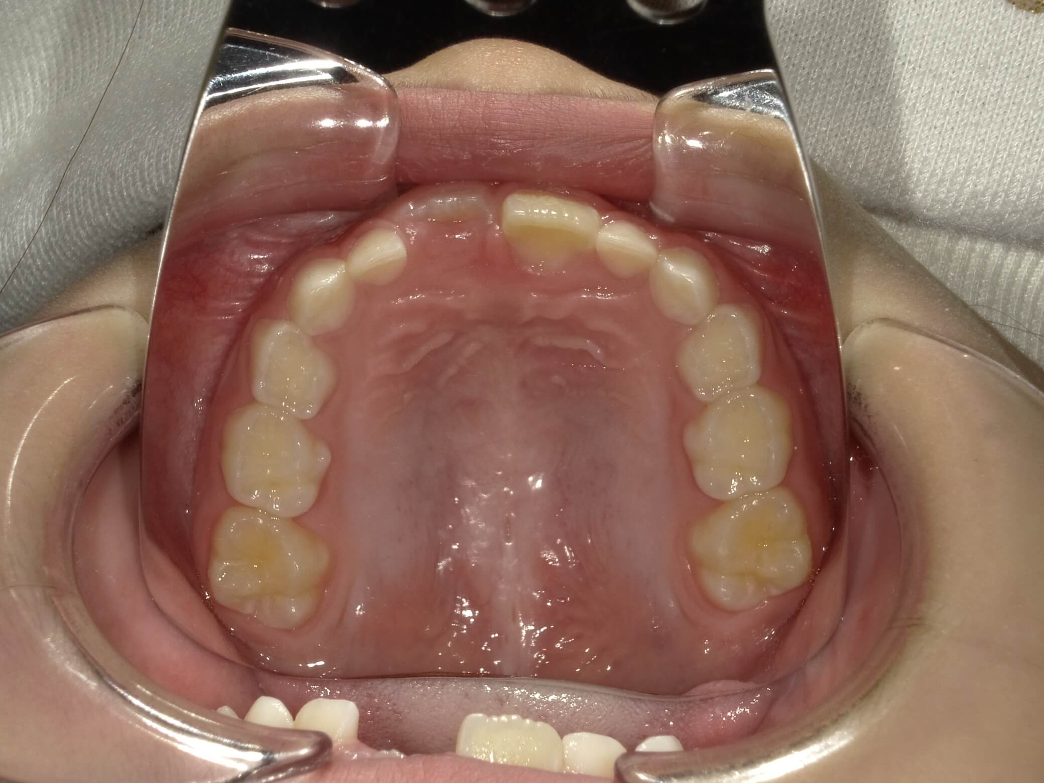 施術前の口内写真04