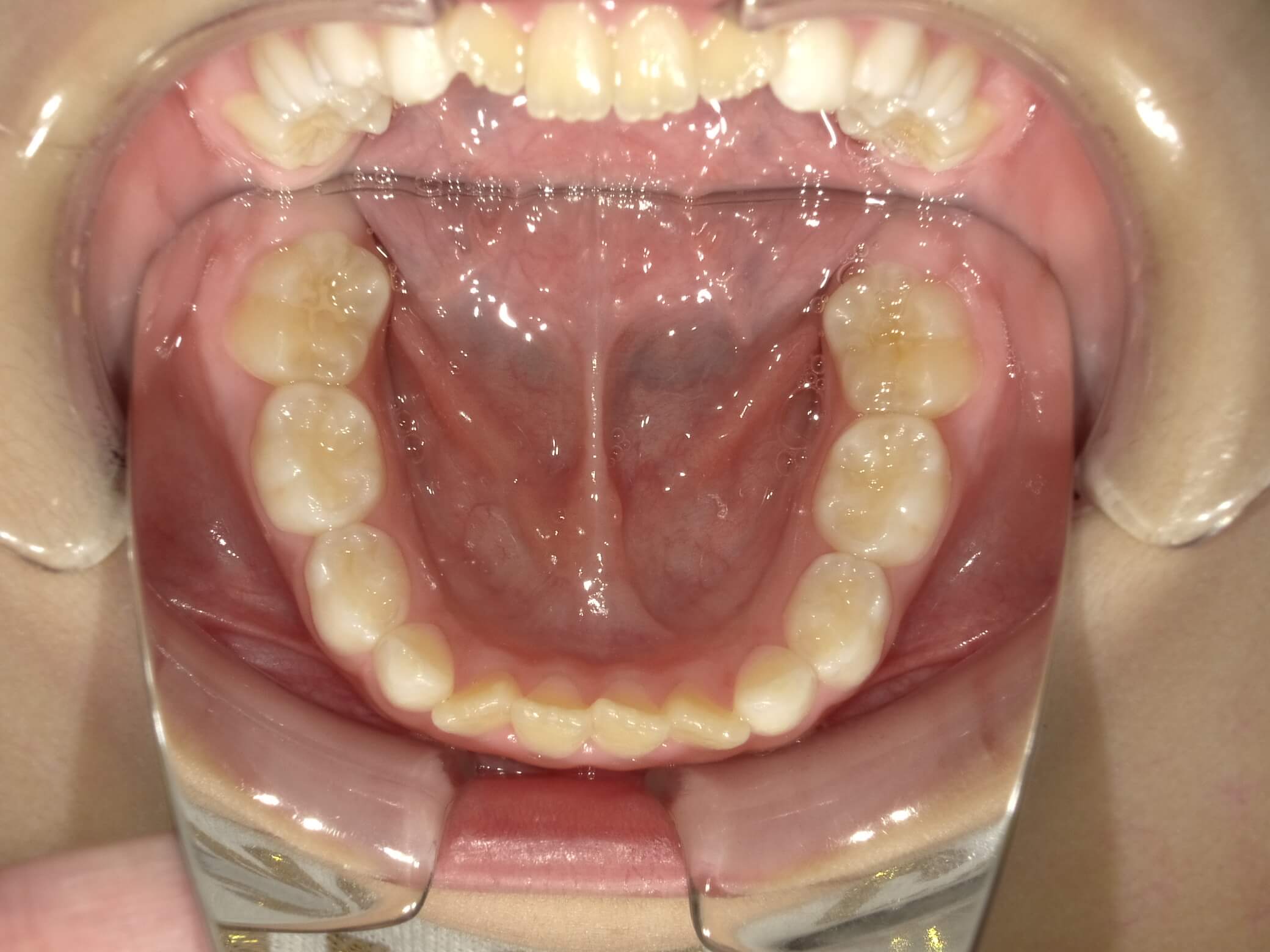 施術前の口内写真05