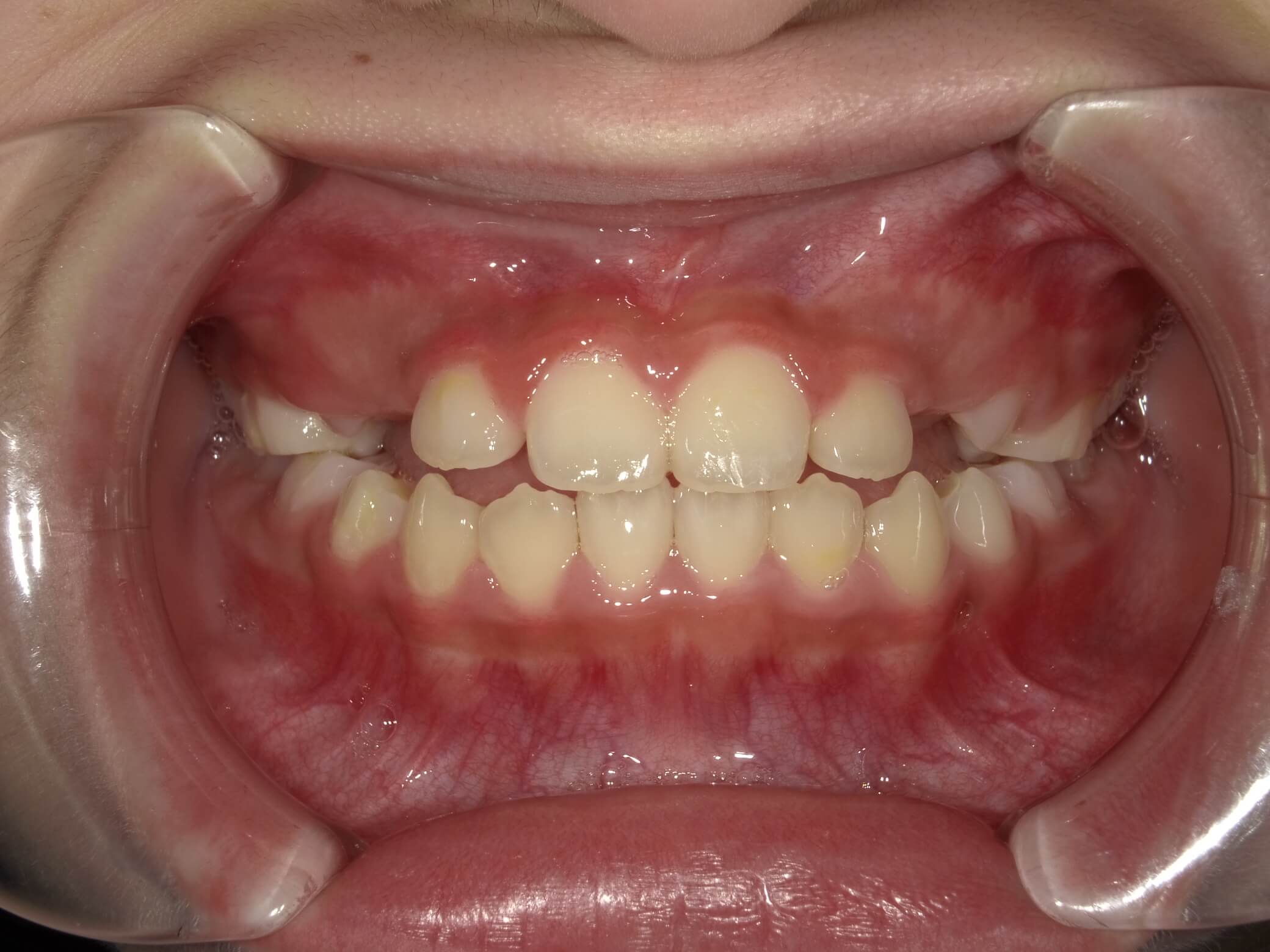 施術後の口内写真01