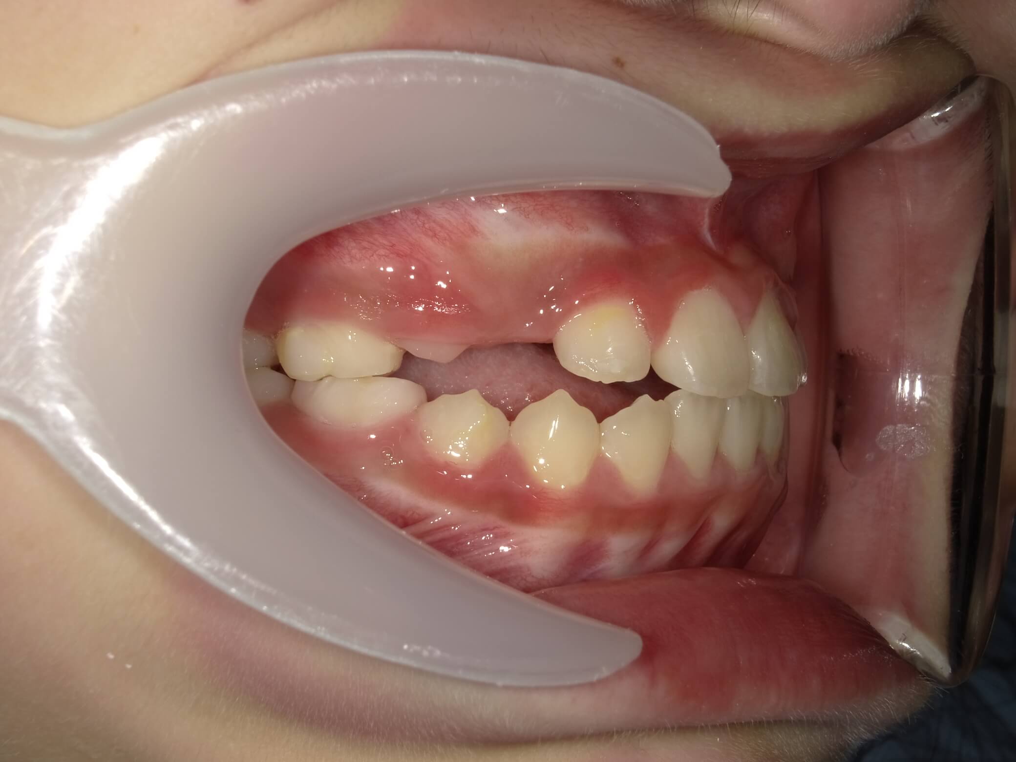 施術後の口内写真02