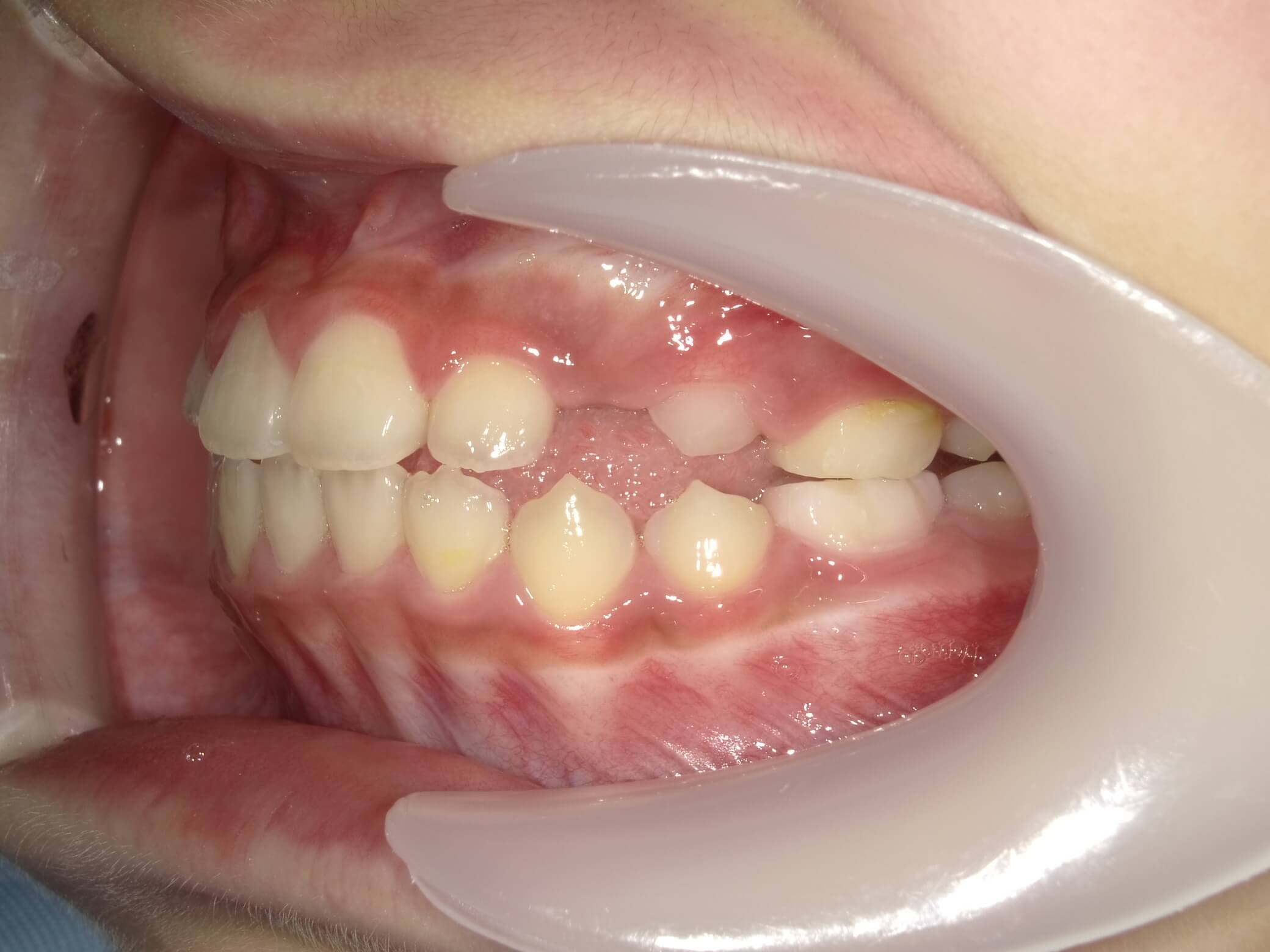施術後の口内写真03