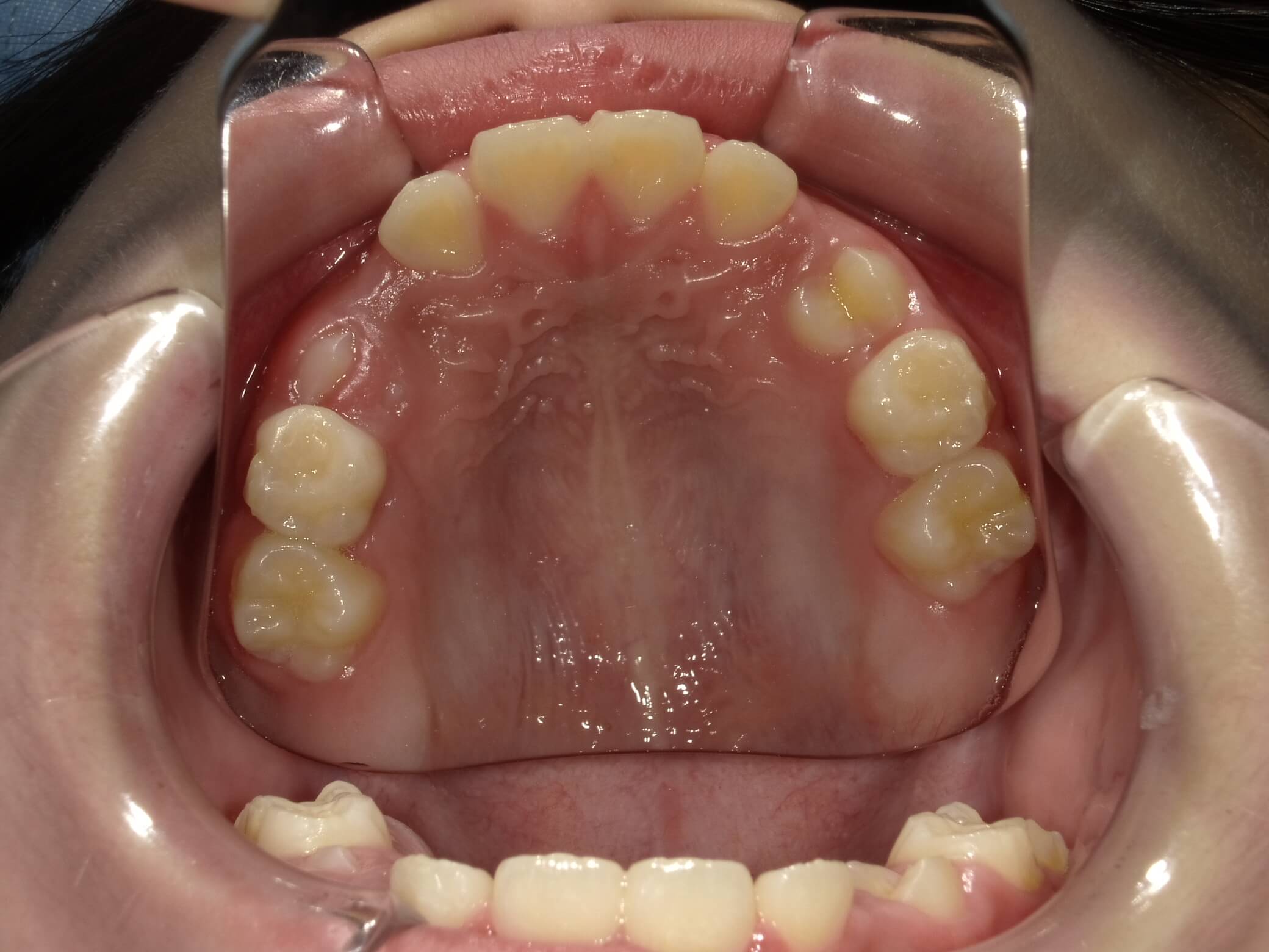 施術後の口内写真04