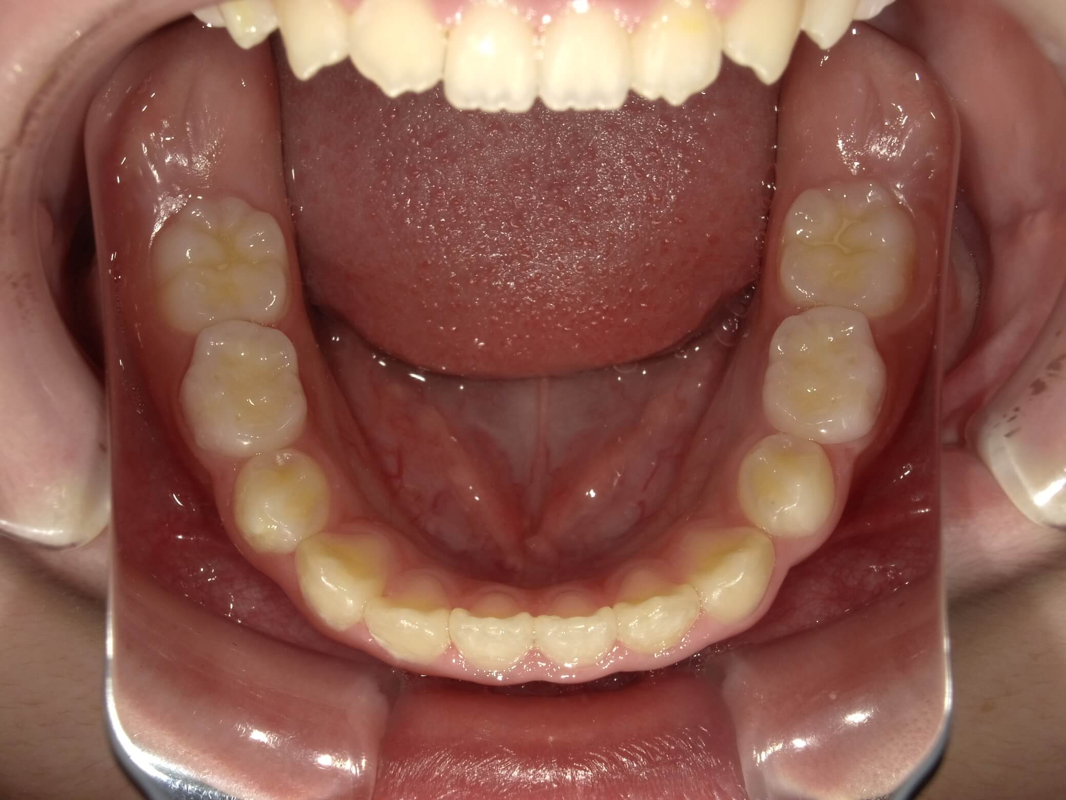 施術後の口内写真05