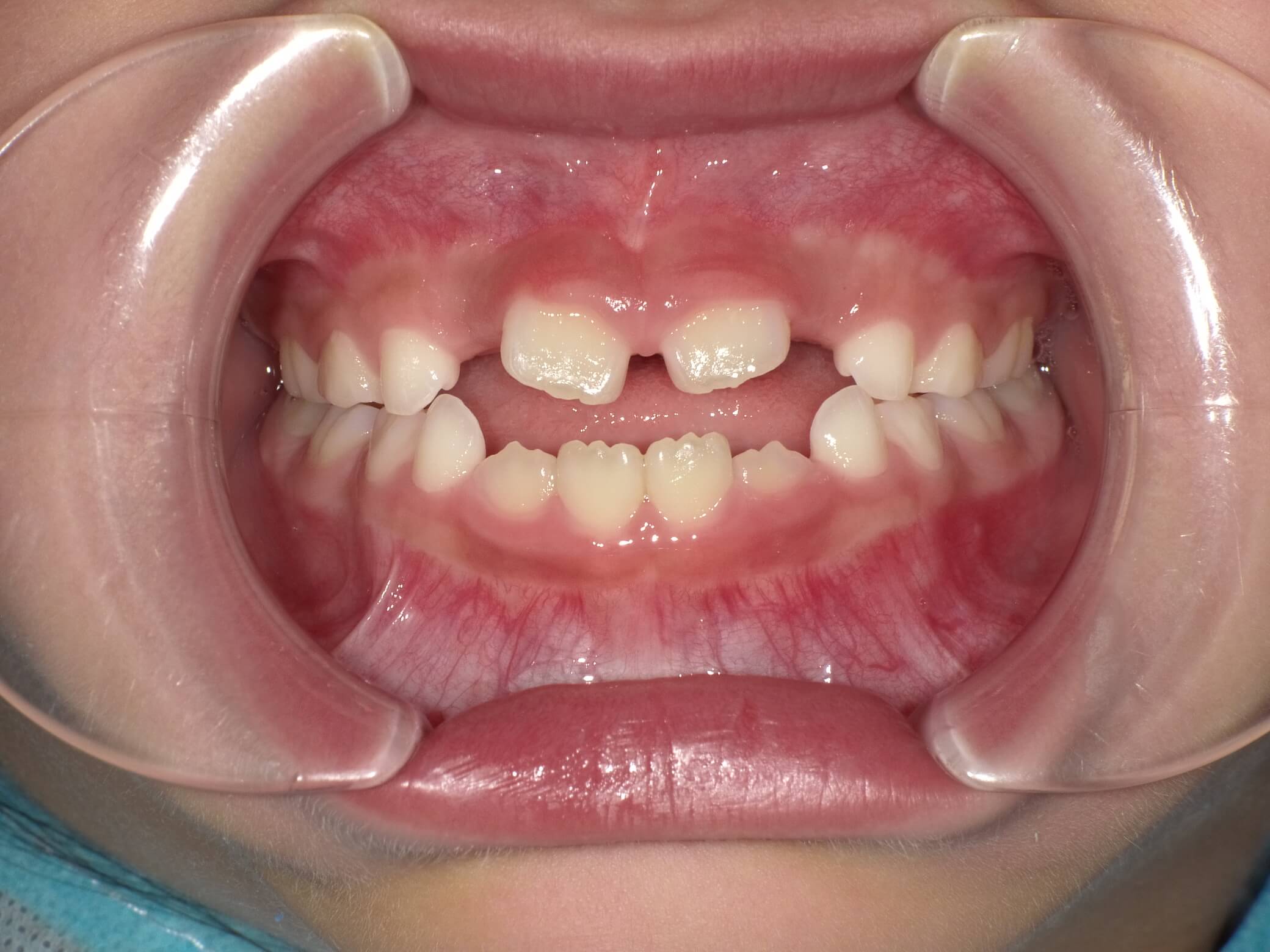 施術前の口内写真01