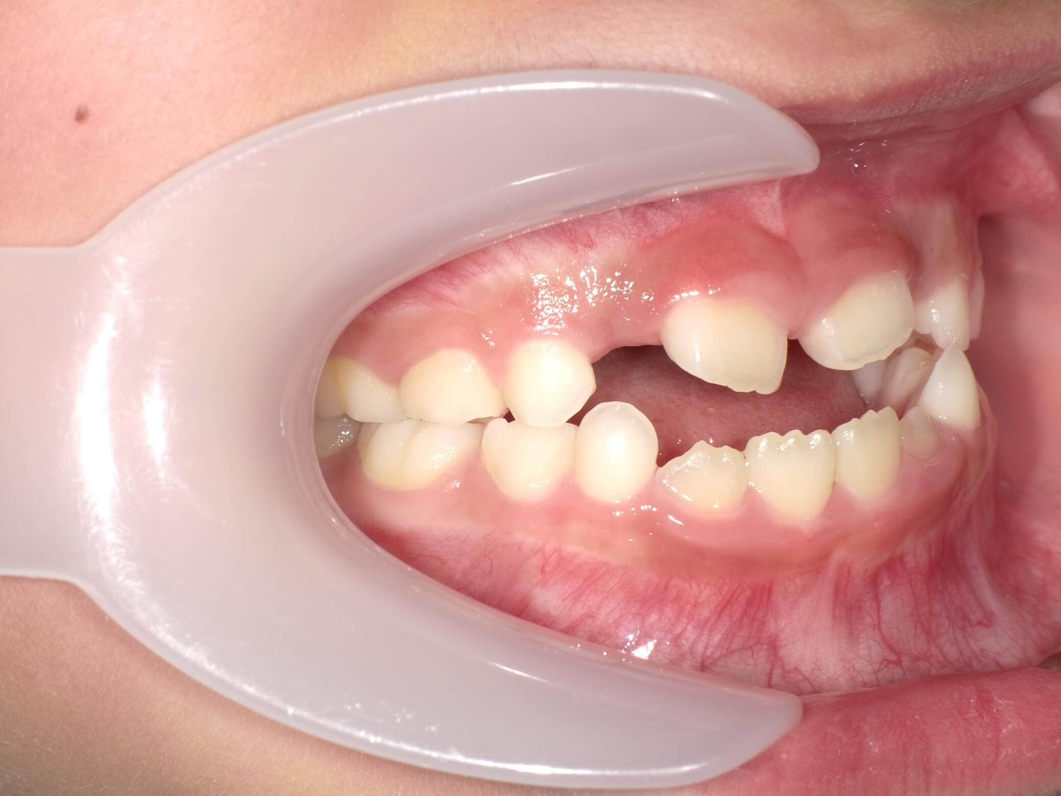 施術前の口内写真02