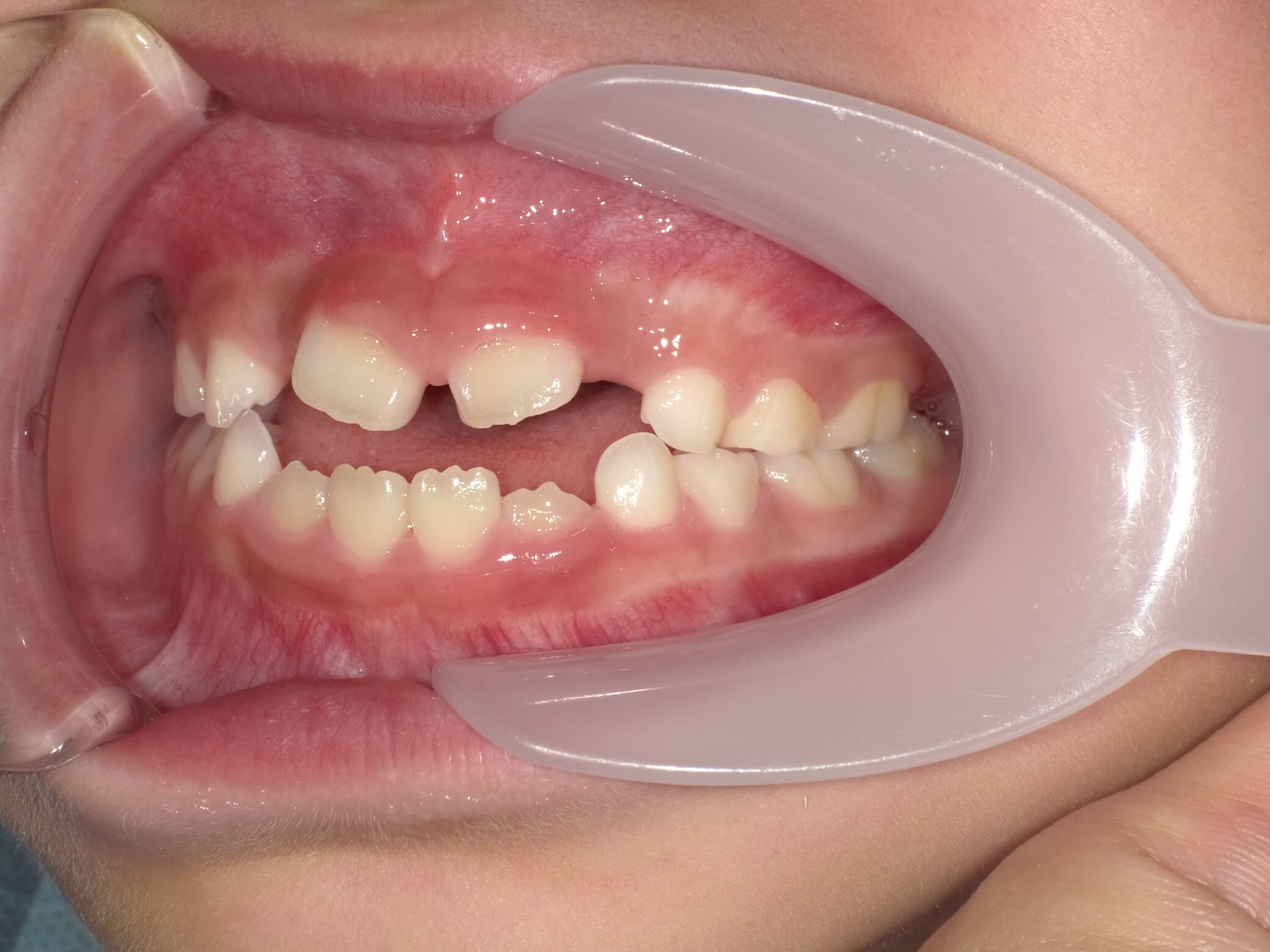 施術前の口内写真03