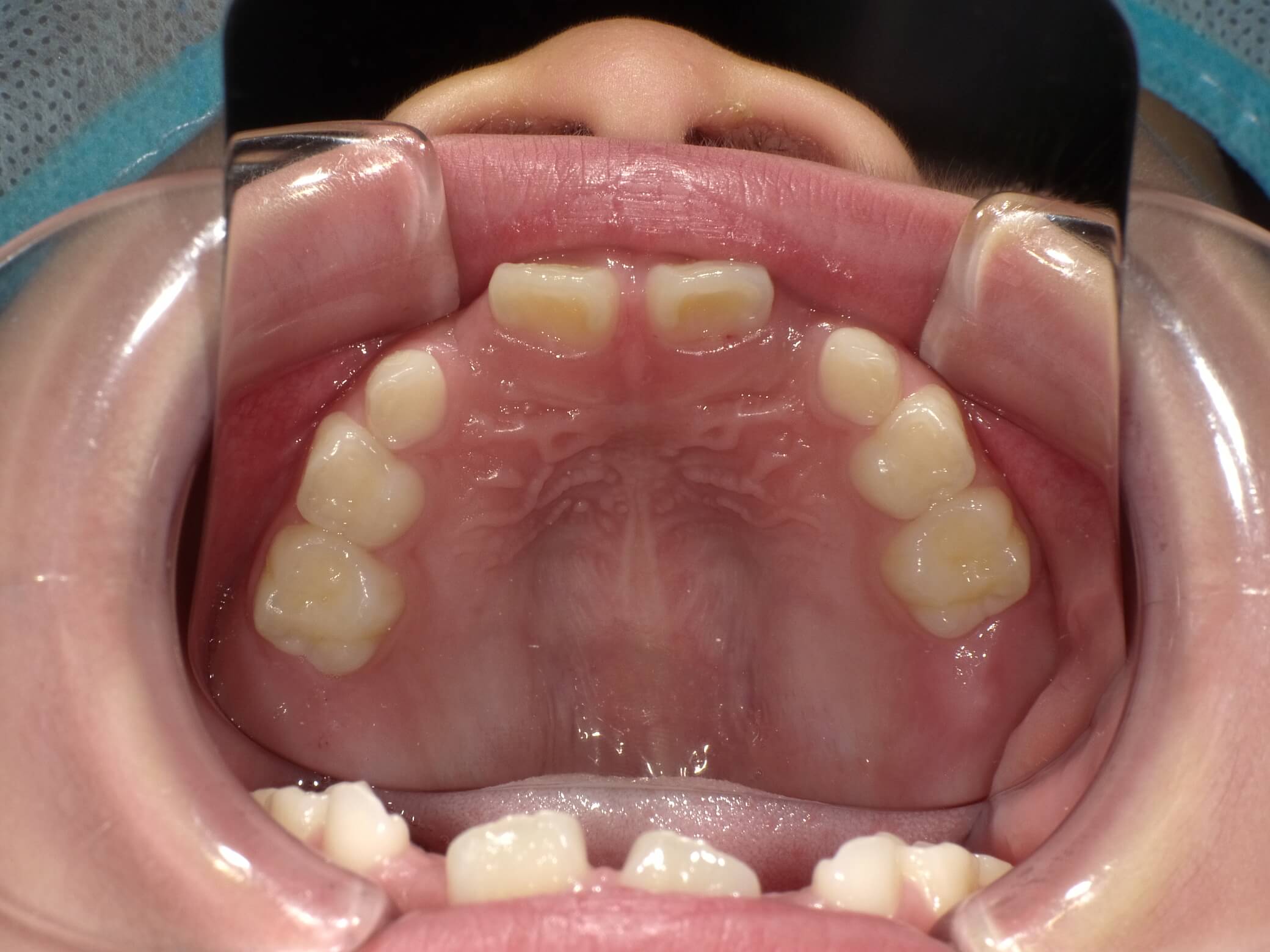 施術前の口内写真04