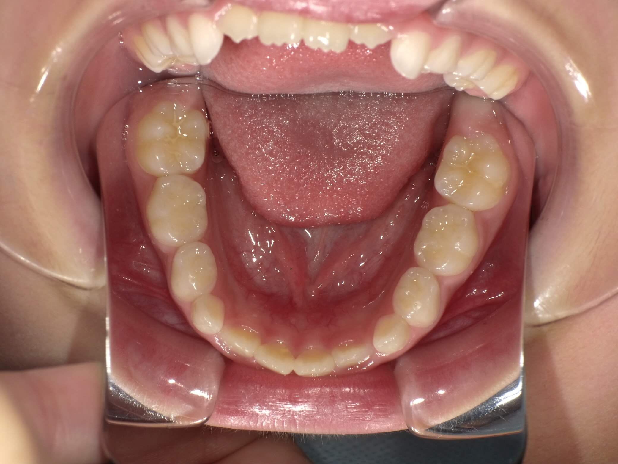 施術前の口内写真05