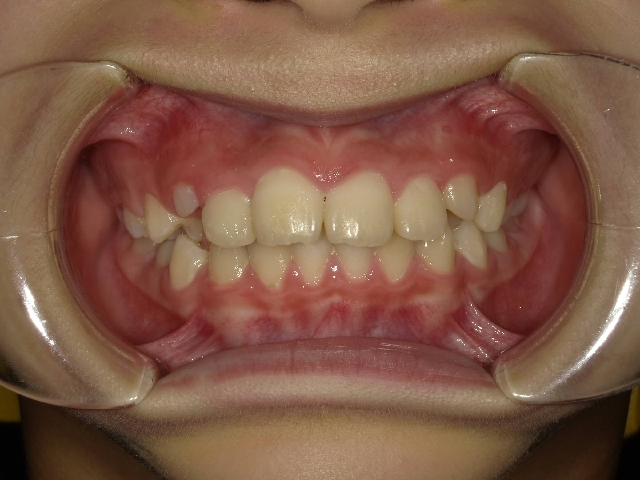 施術後の口内写真01