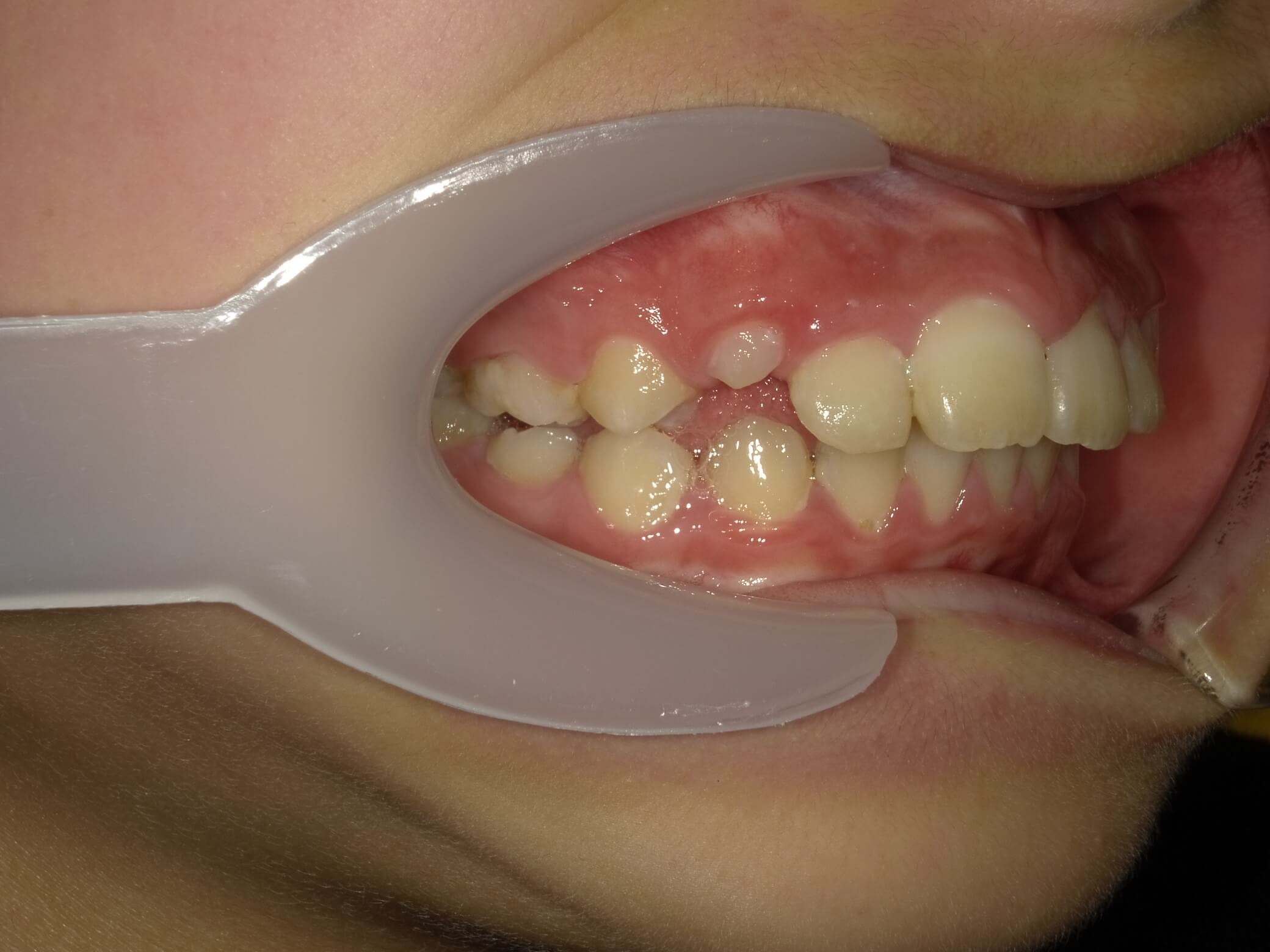施術後の口内写真02